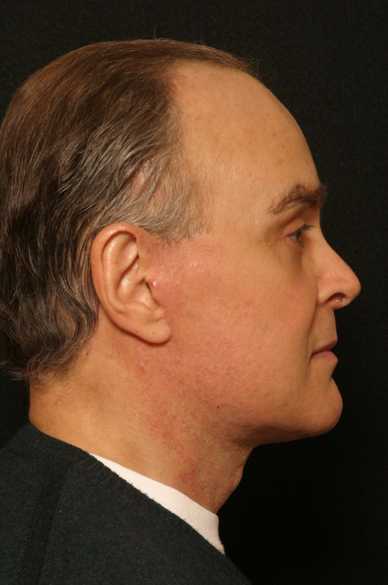 Facelift Before and After After