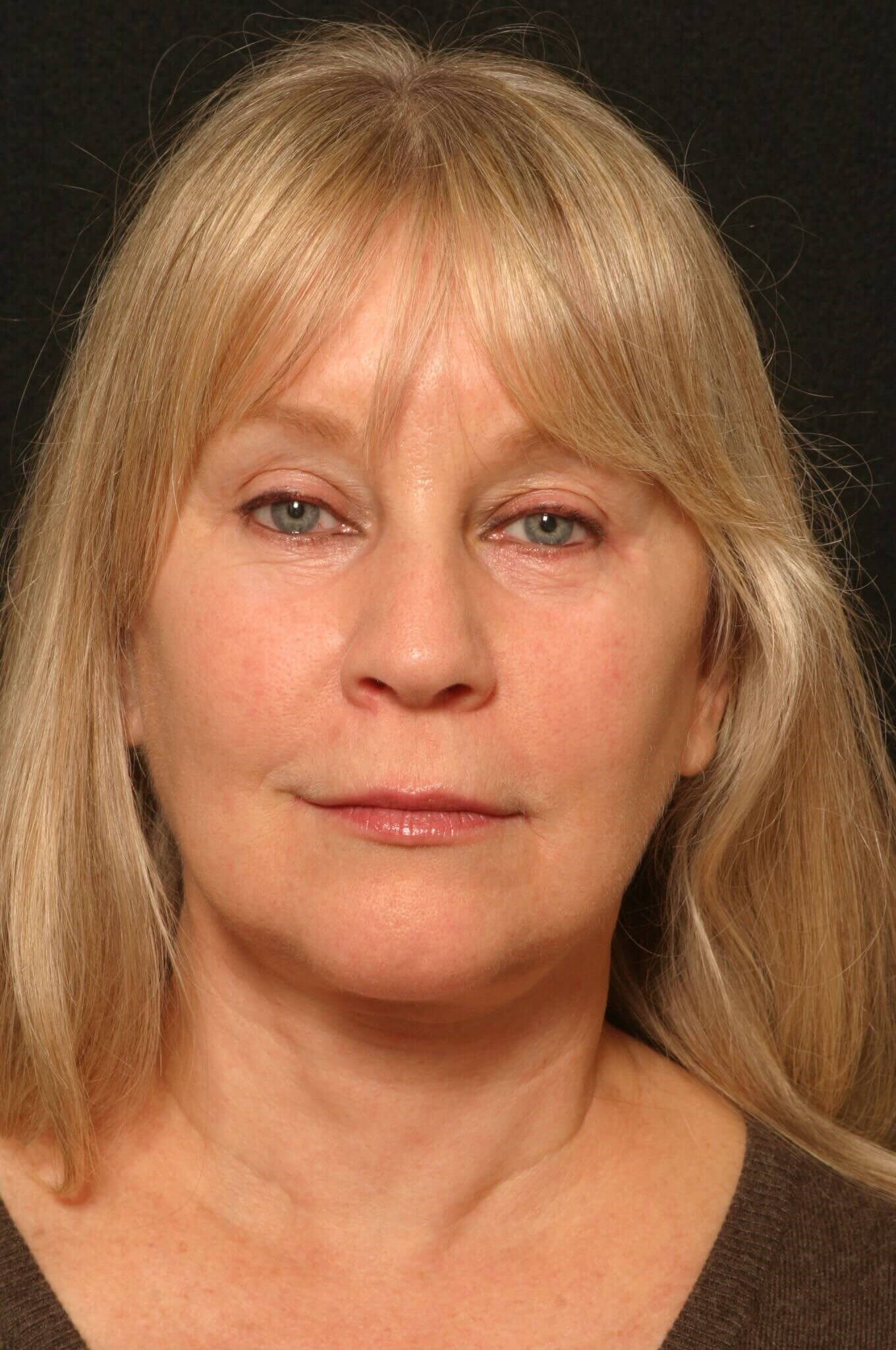 Facelift Before and After After