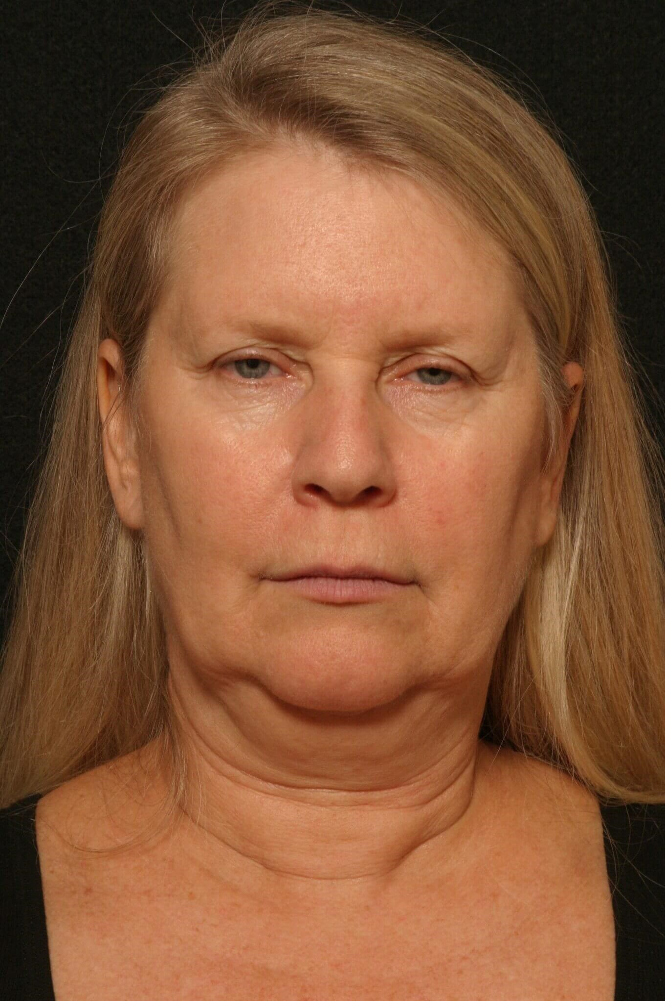 Facelift Before and After Before