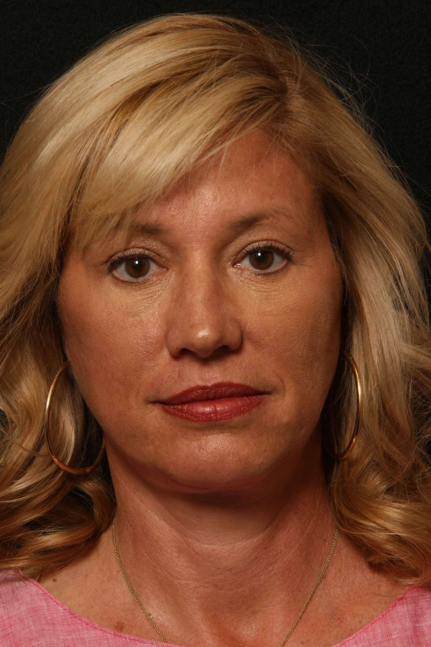 Facelift Before and After After