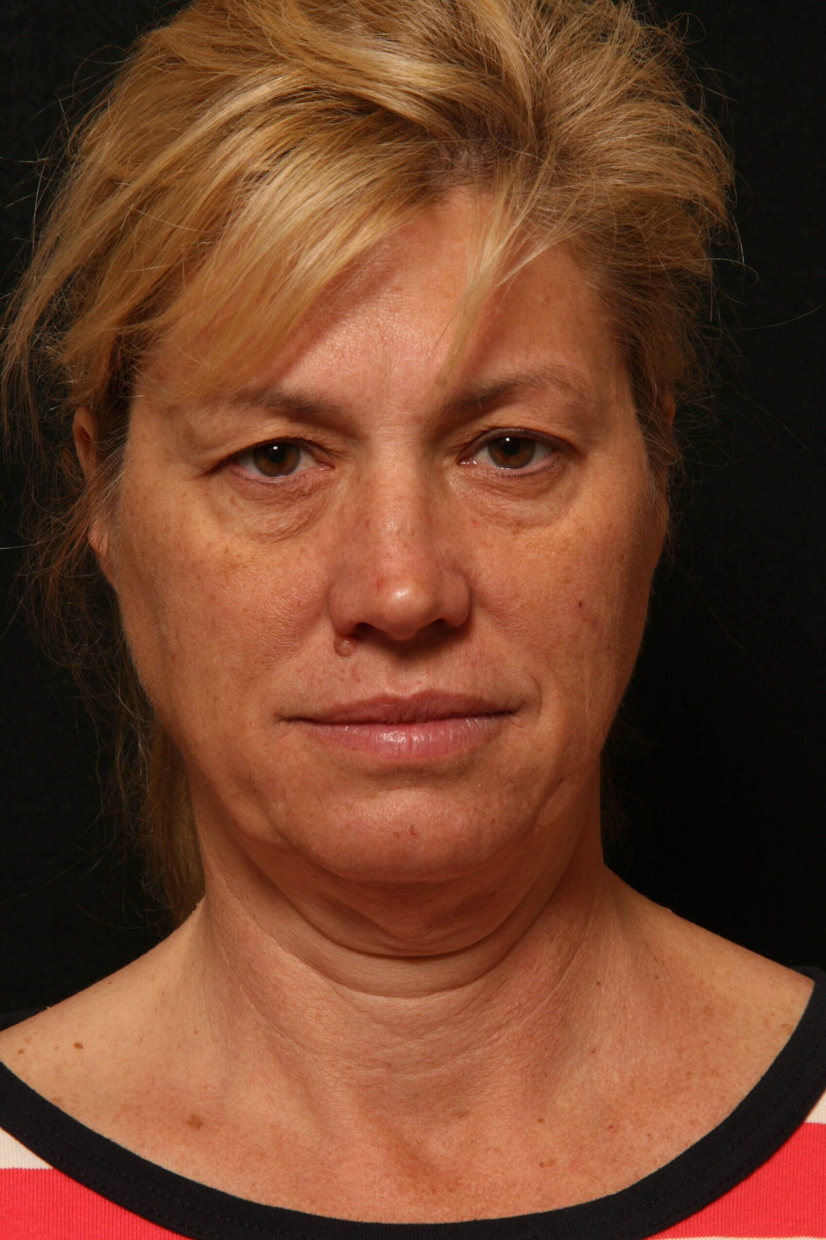 Facelift Before and After Before