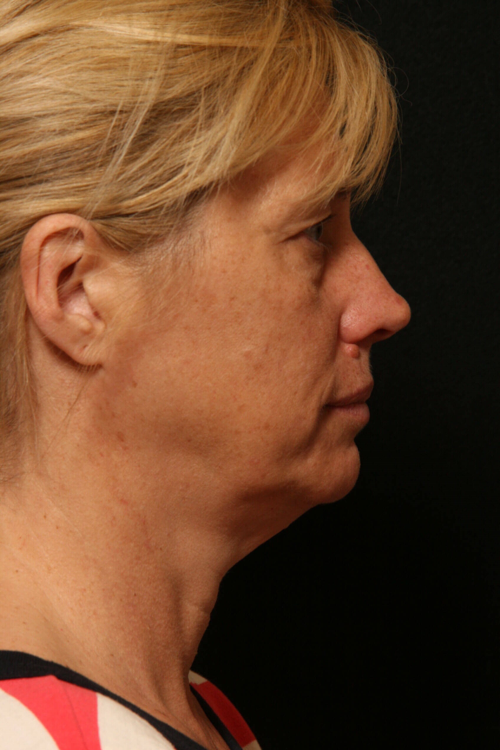 Facelift Before and After Before