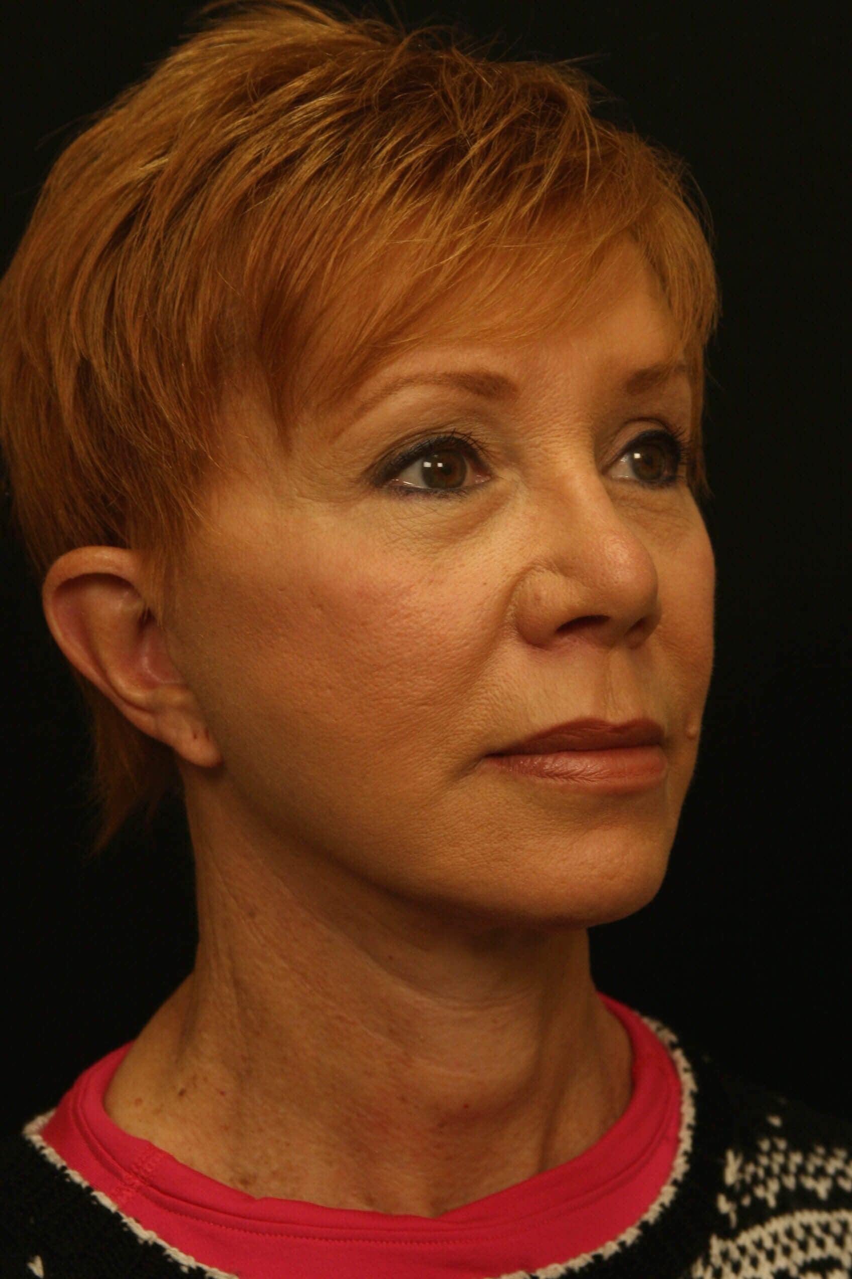 Facelift Before and After After