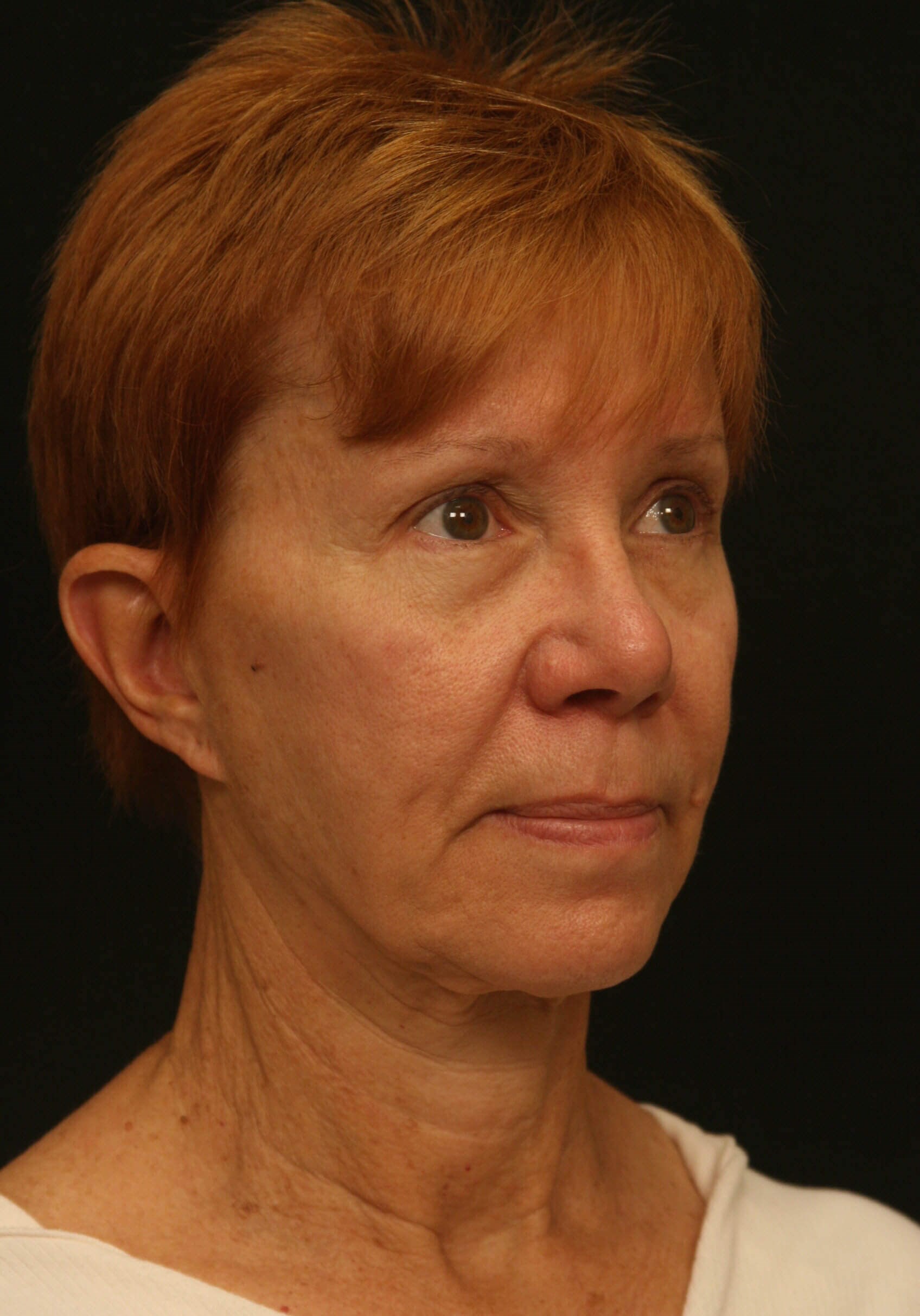 Facelift Before and After Before