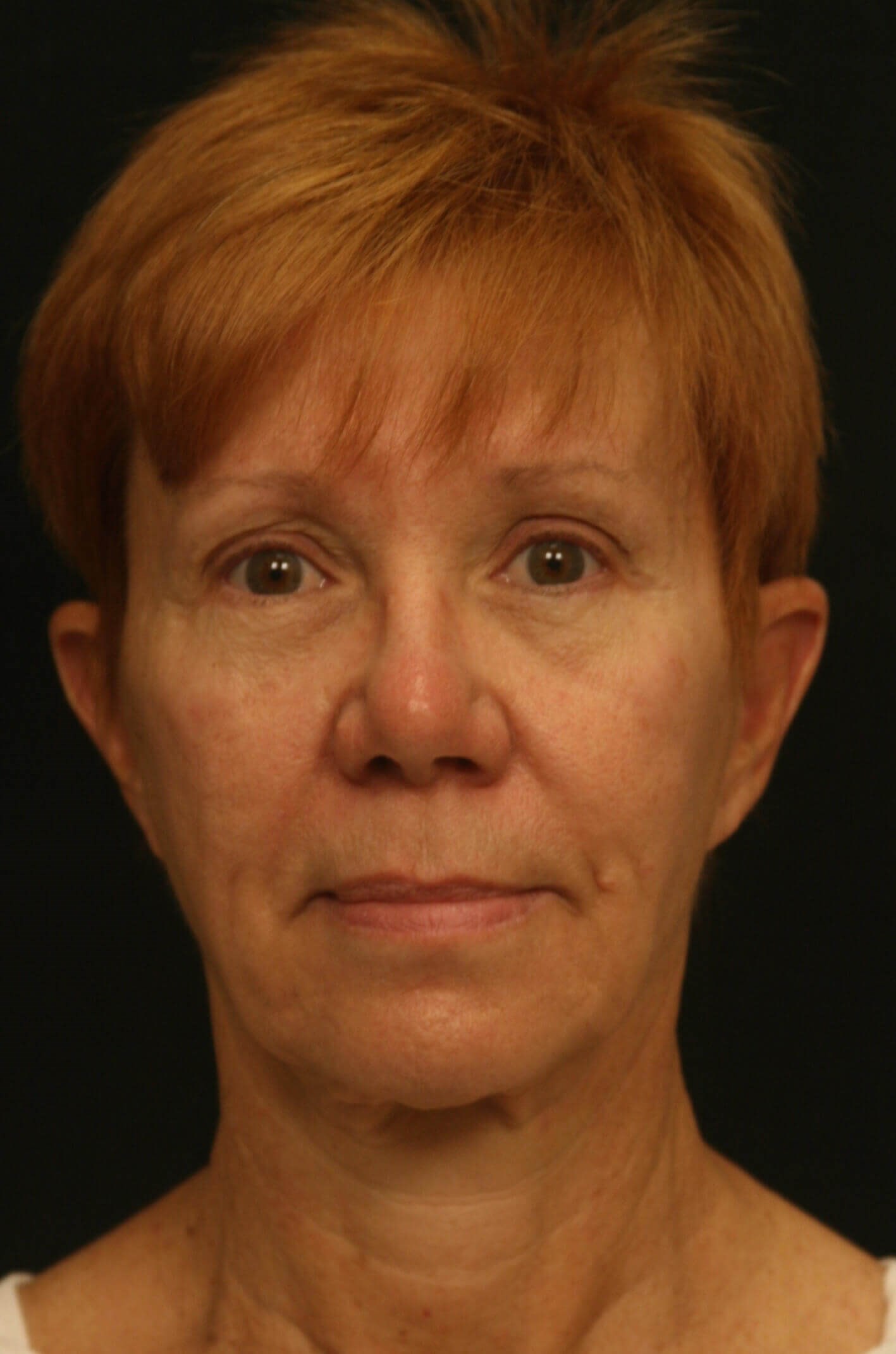 Facelift Before and After Before