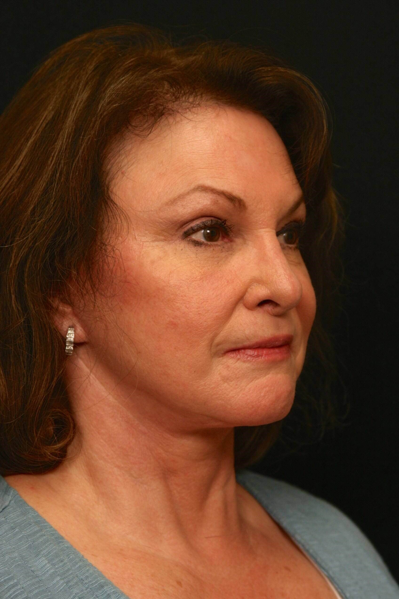 Facelift Before and After After