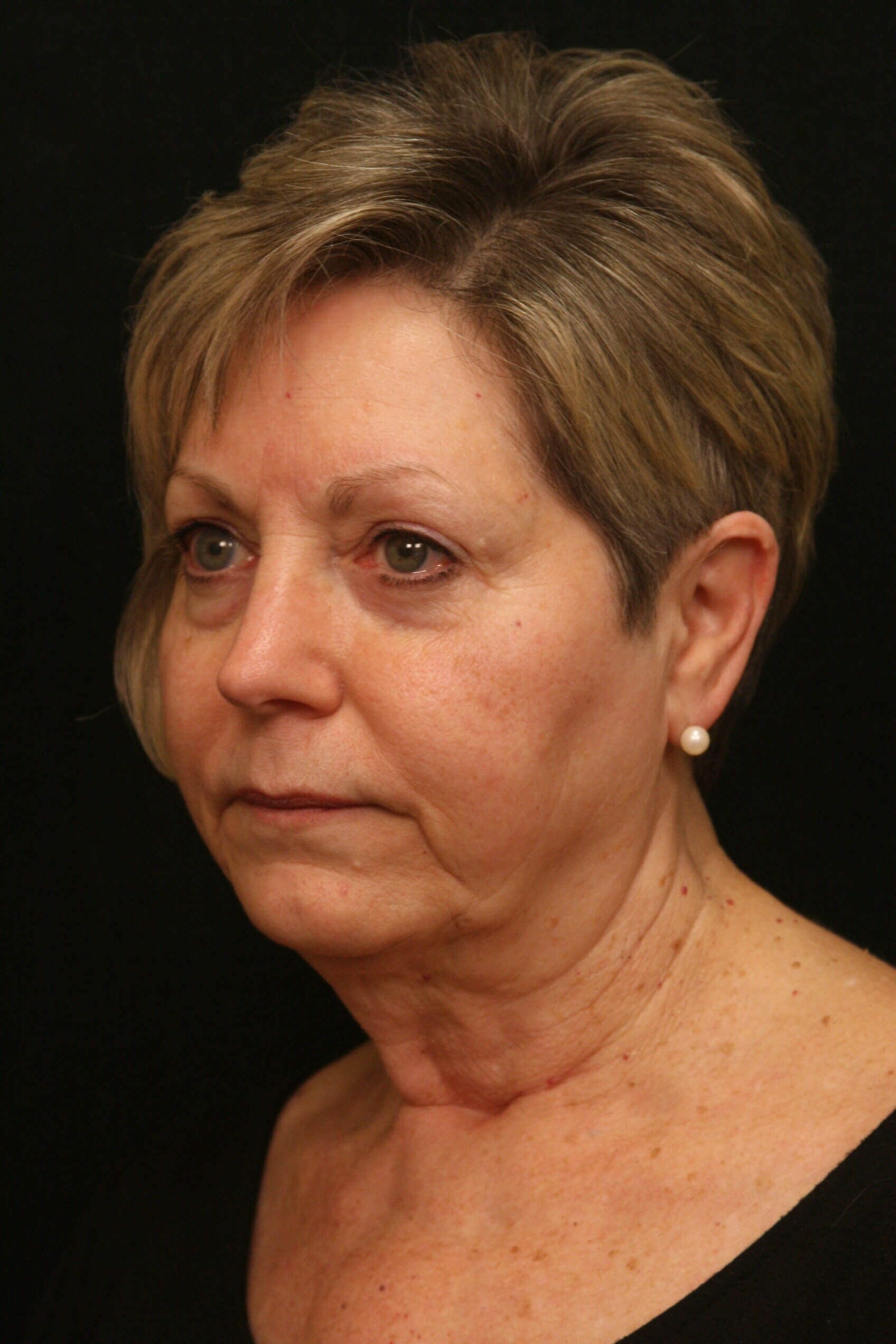 Facelift Before and After Before