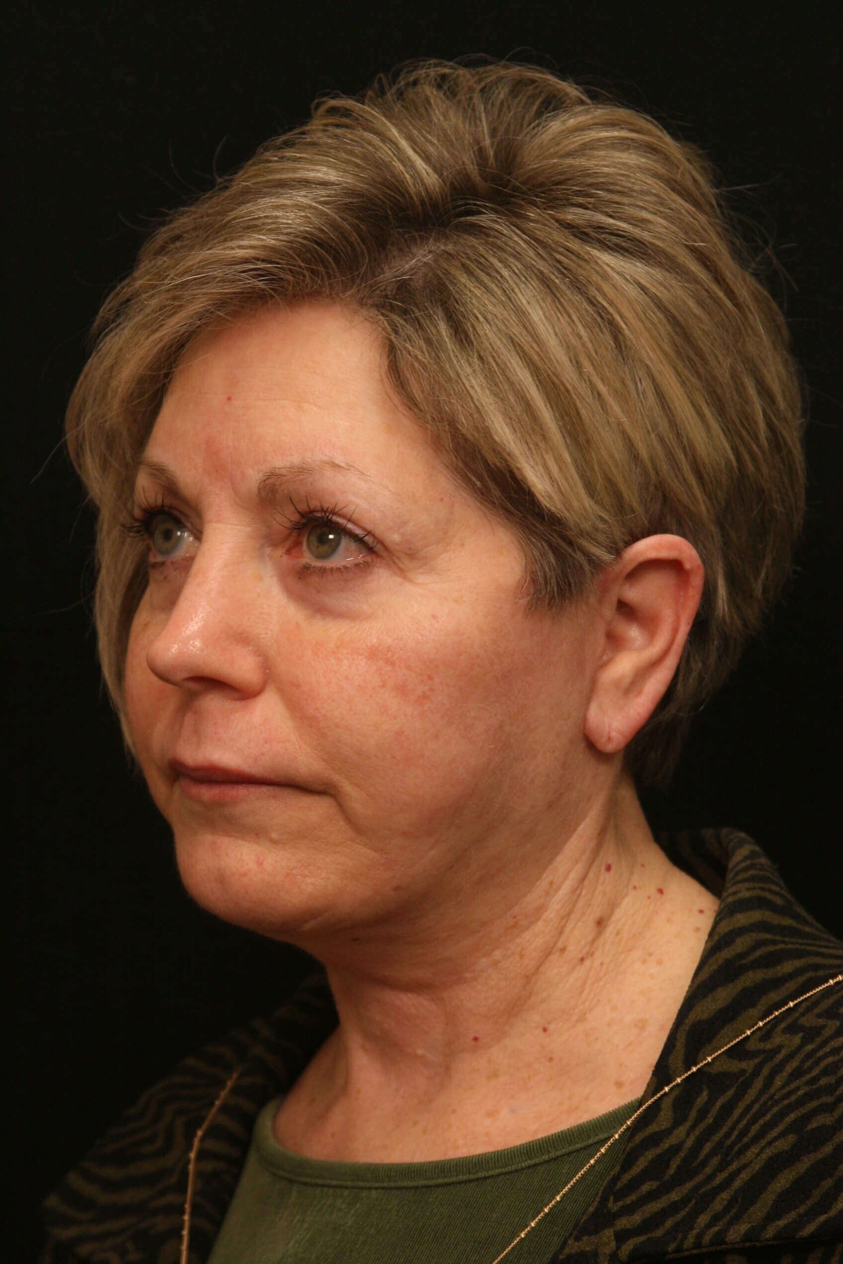 Facelift Before and After After