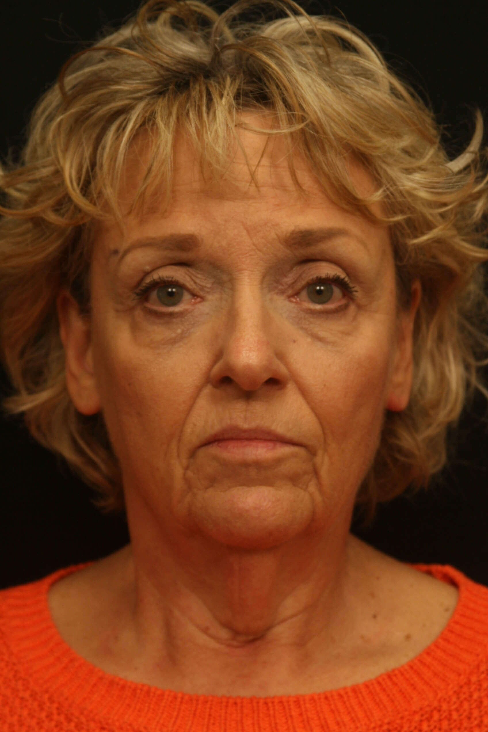 Facelift Before and After Before