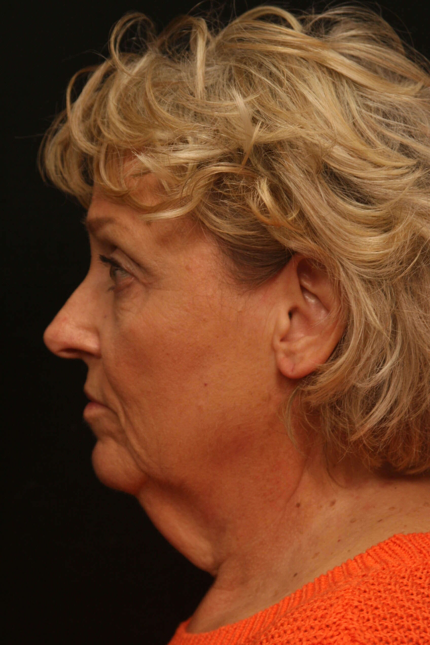 Facelift Before and After Before