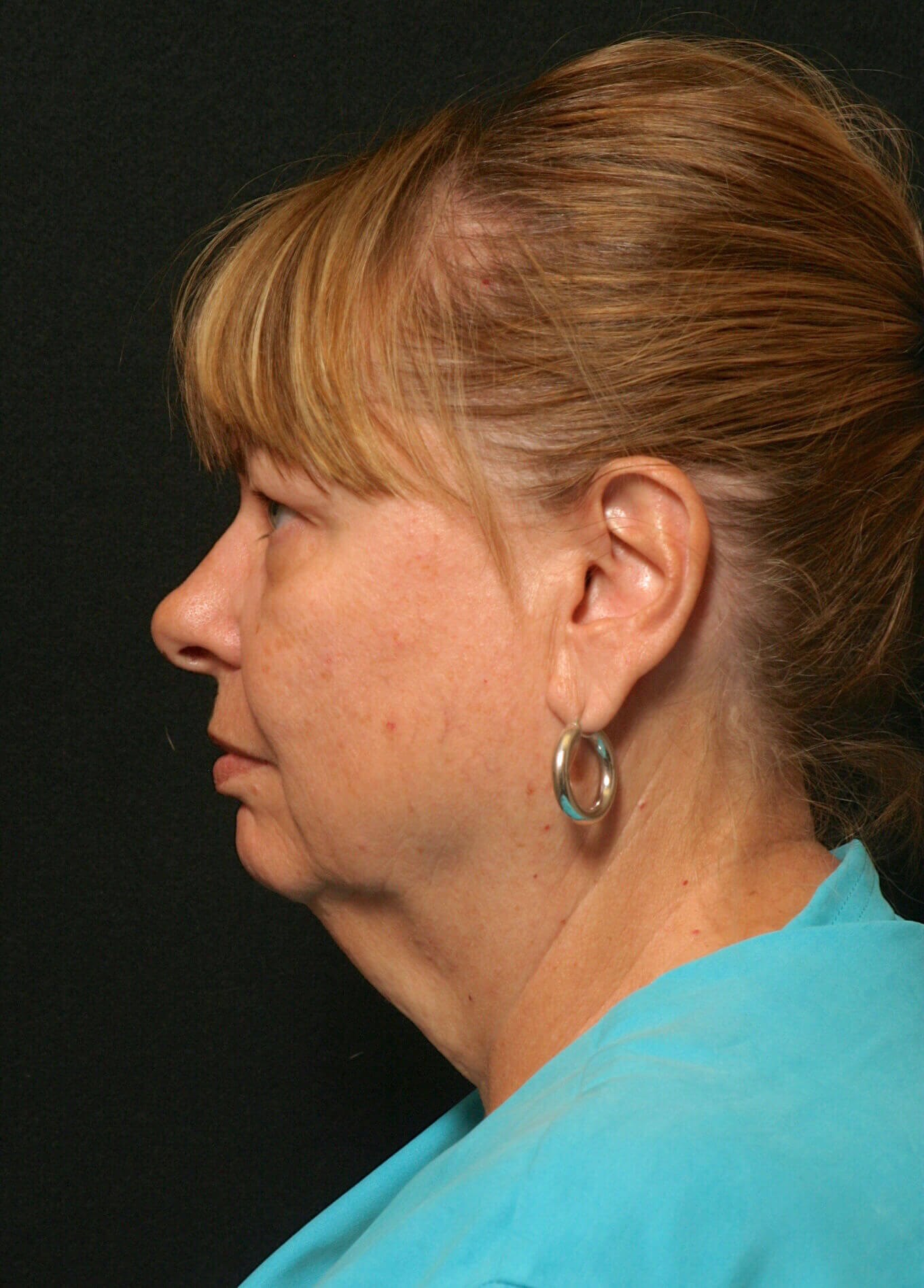 Facelift Before and After Before
