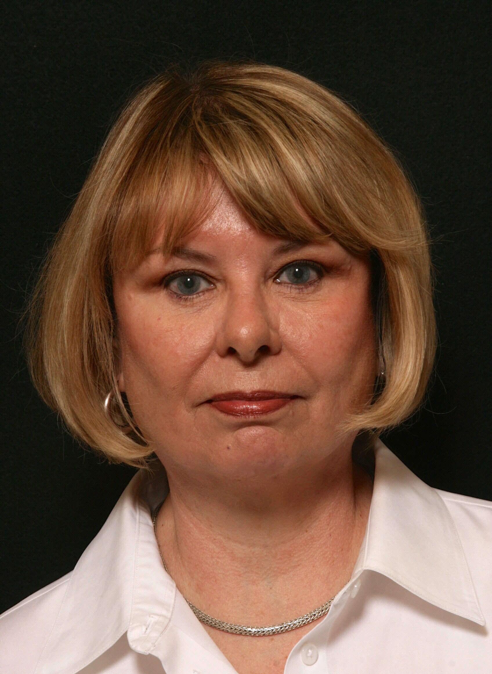 Facelift Before and After After