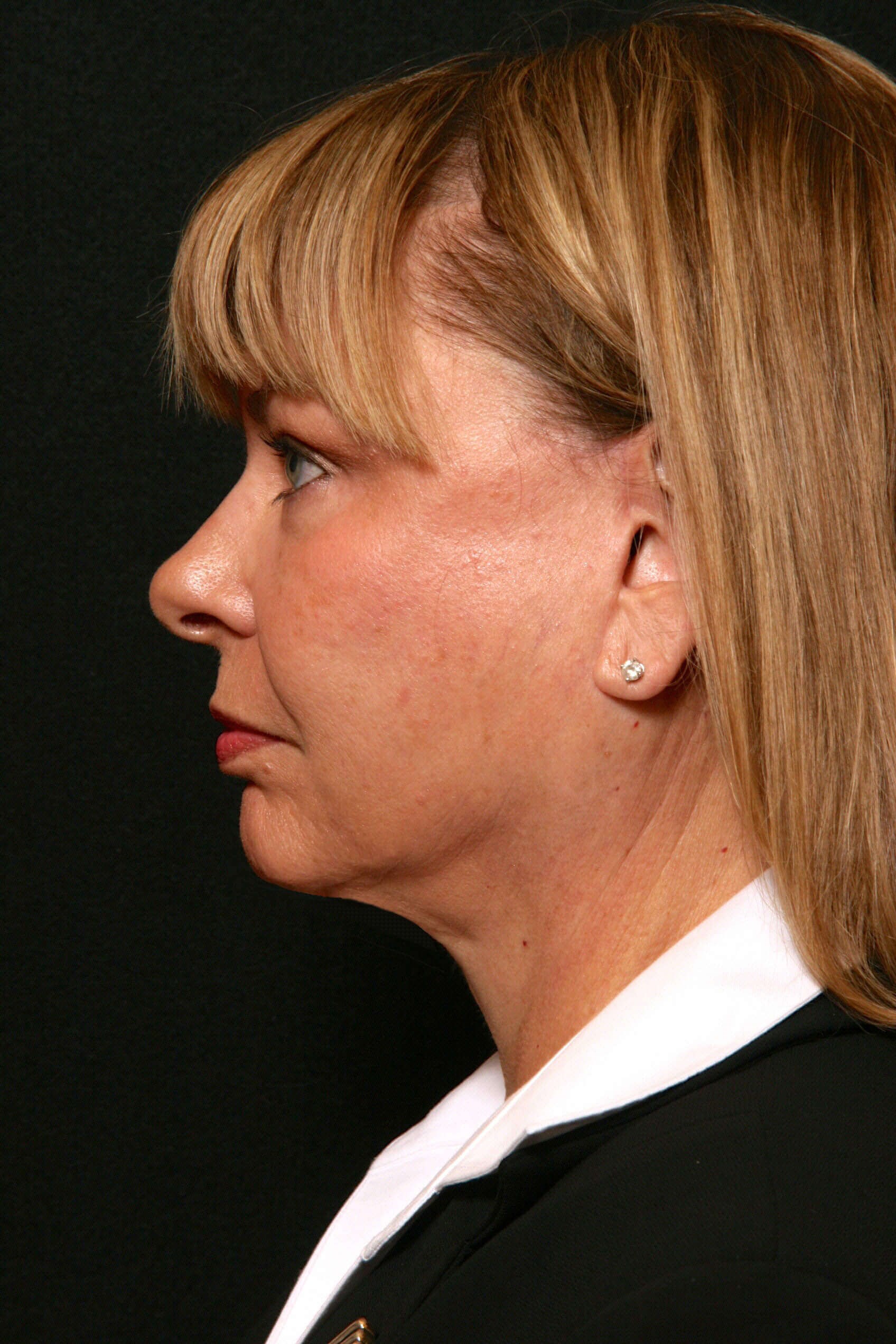 Facelift Before and After After