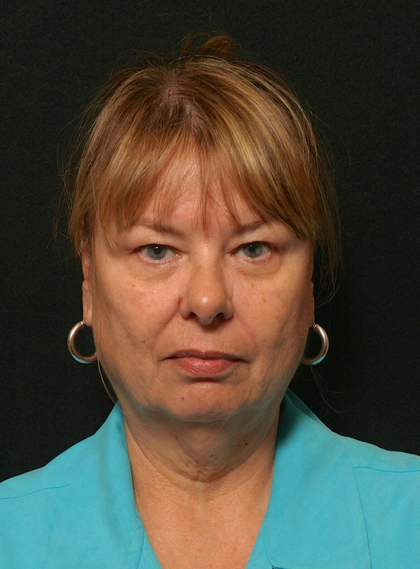 Facelift Before and After Before