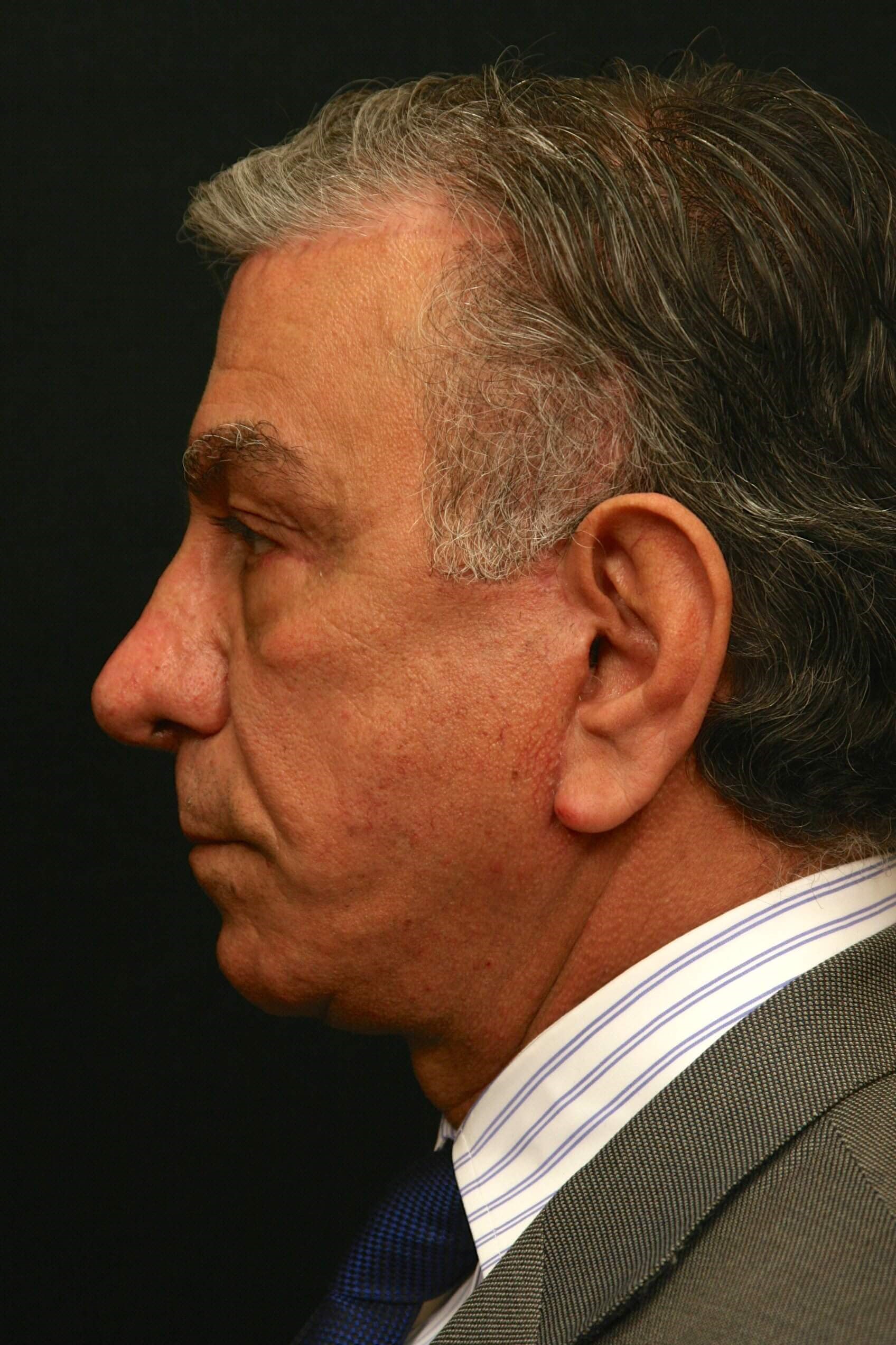 Facelift Before and After After