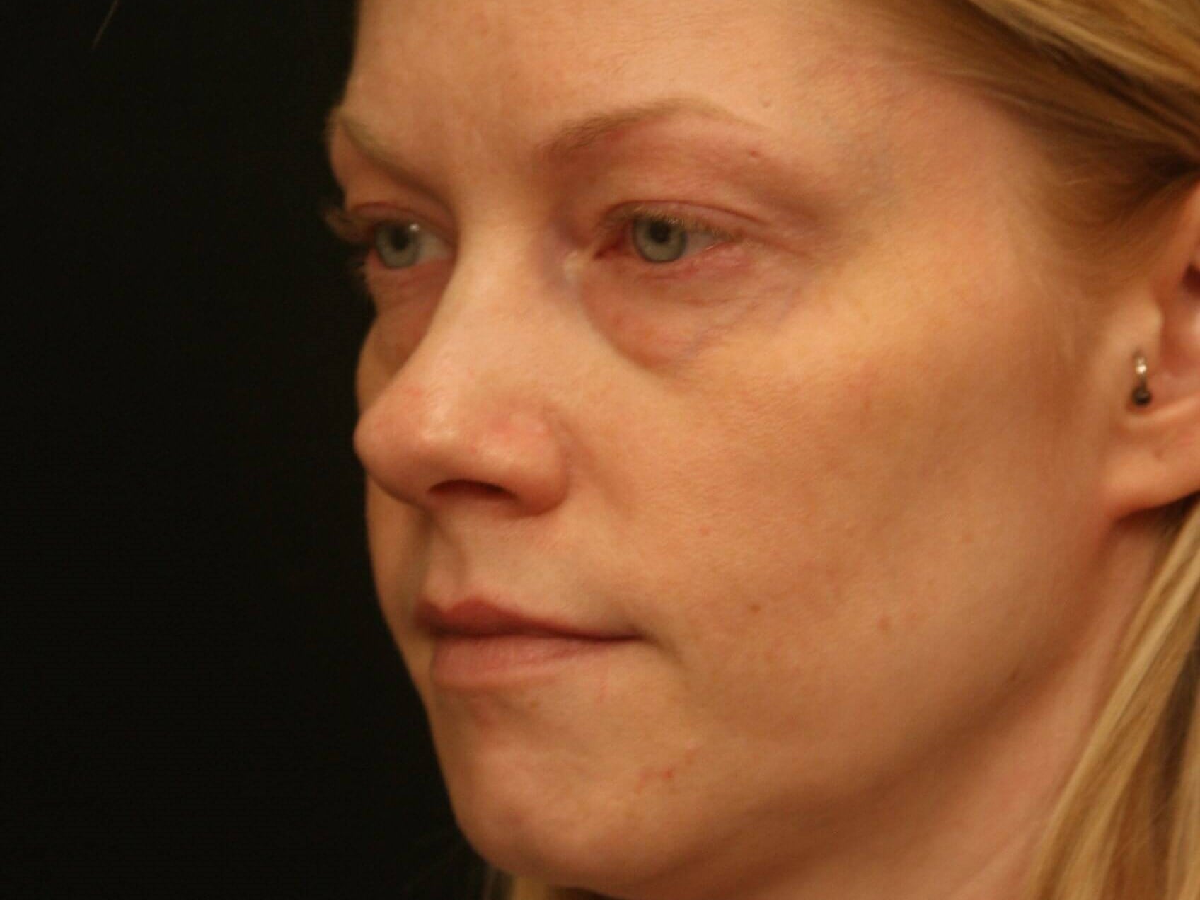Lower Blepharoplasty Before