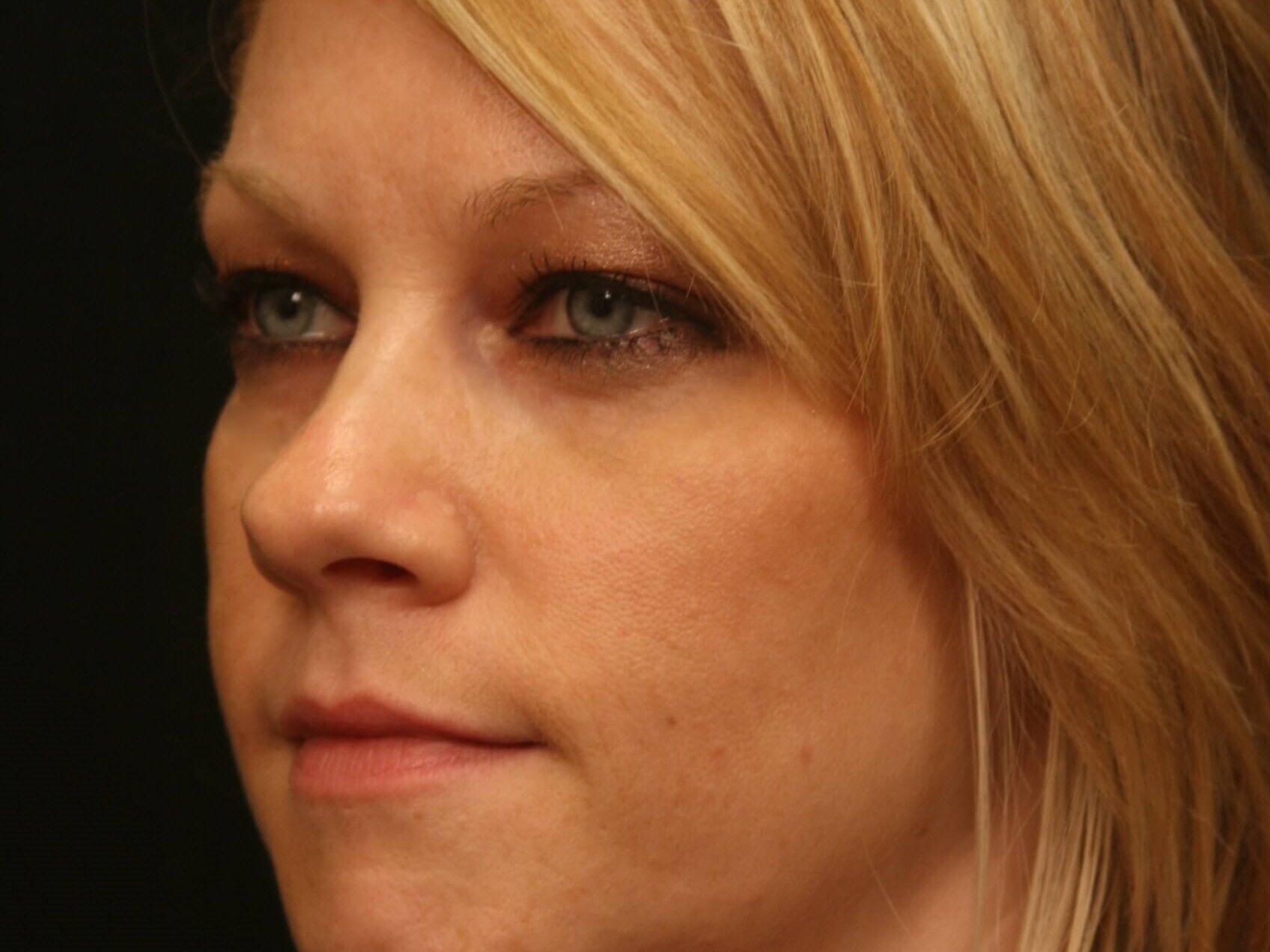 Lower Blepharoplasty After