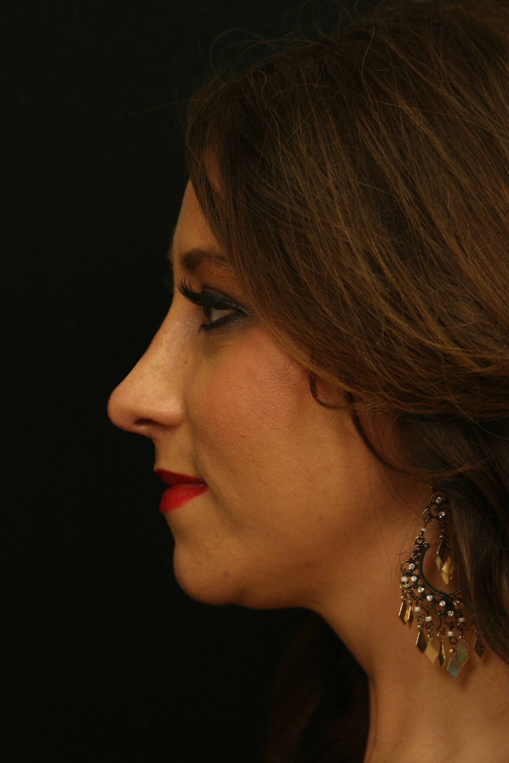 Rhinoplasty Before and After After