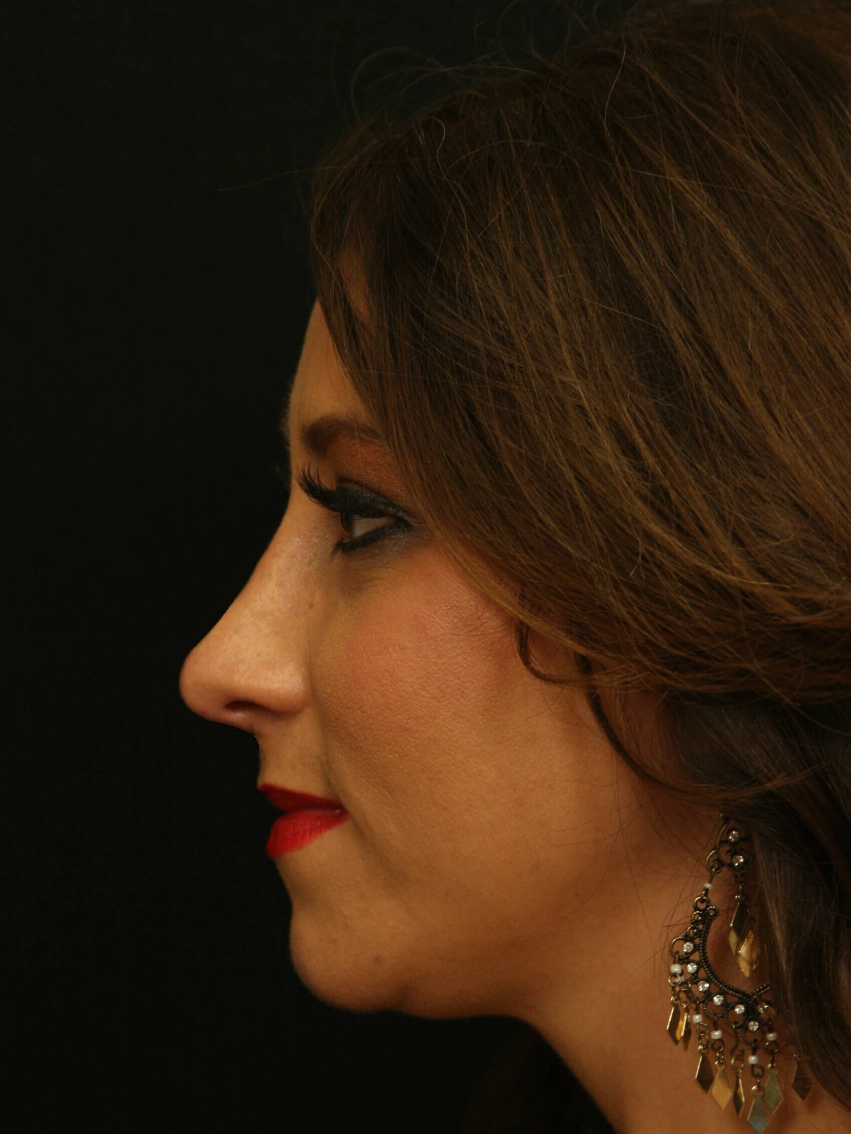 Rhinoplasty Before and After After