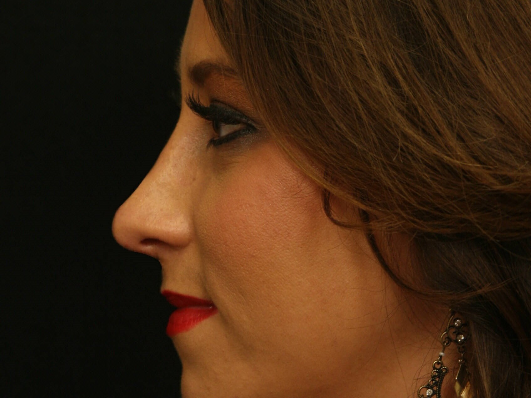 Rhinoplasty Before and After After