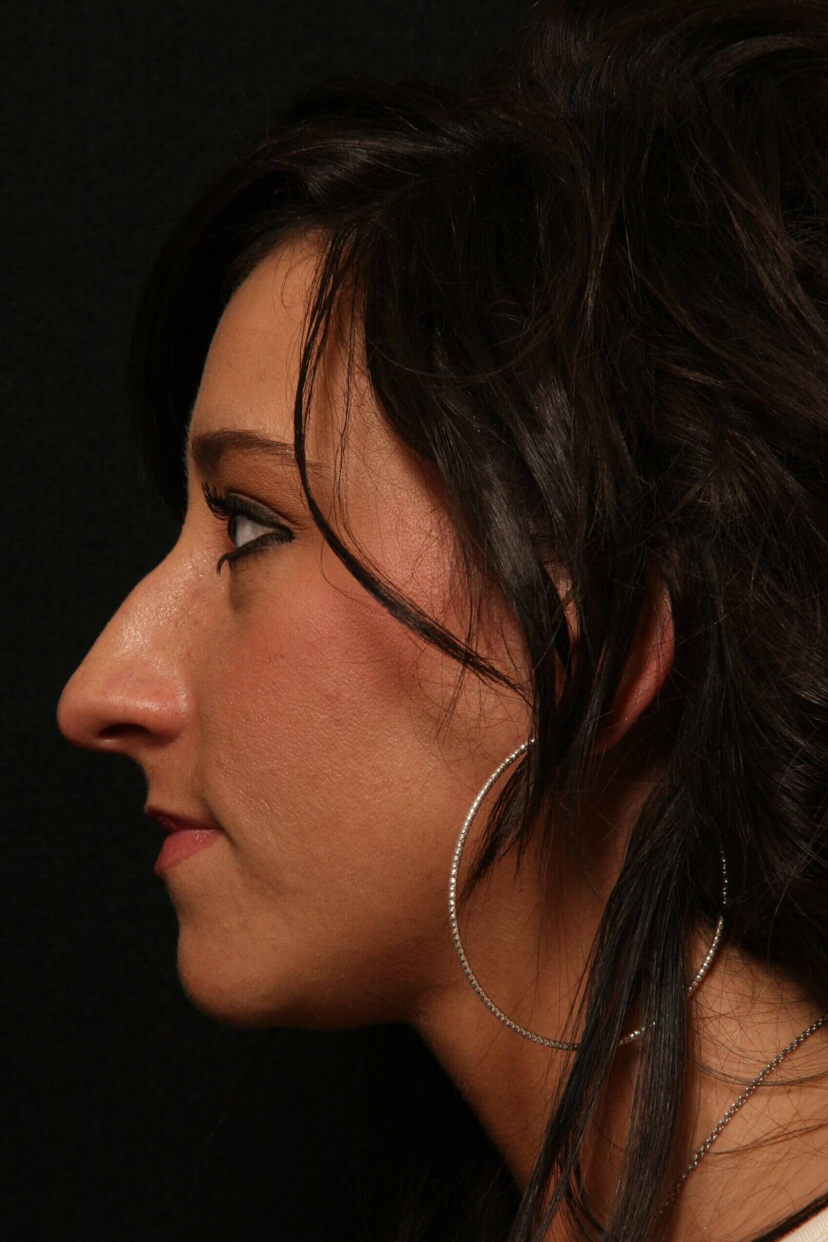 Rhinoplasty Before and After Before