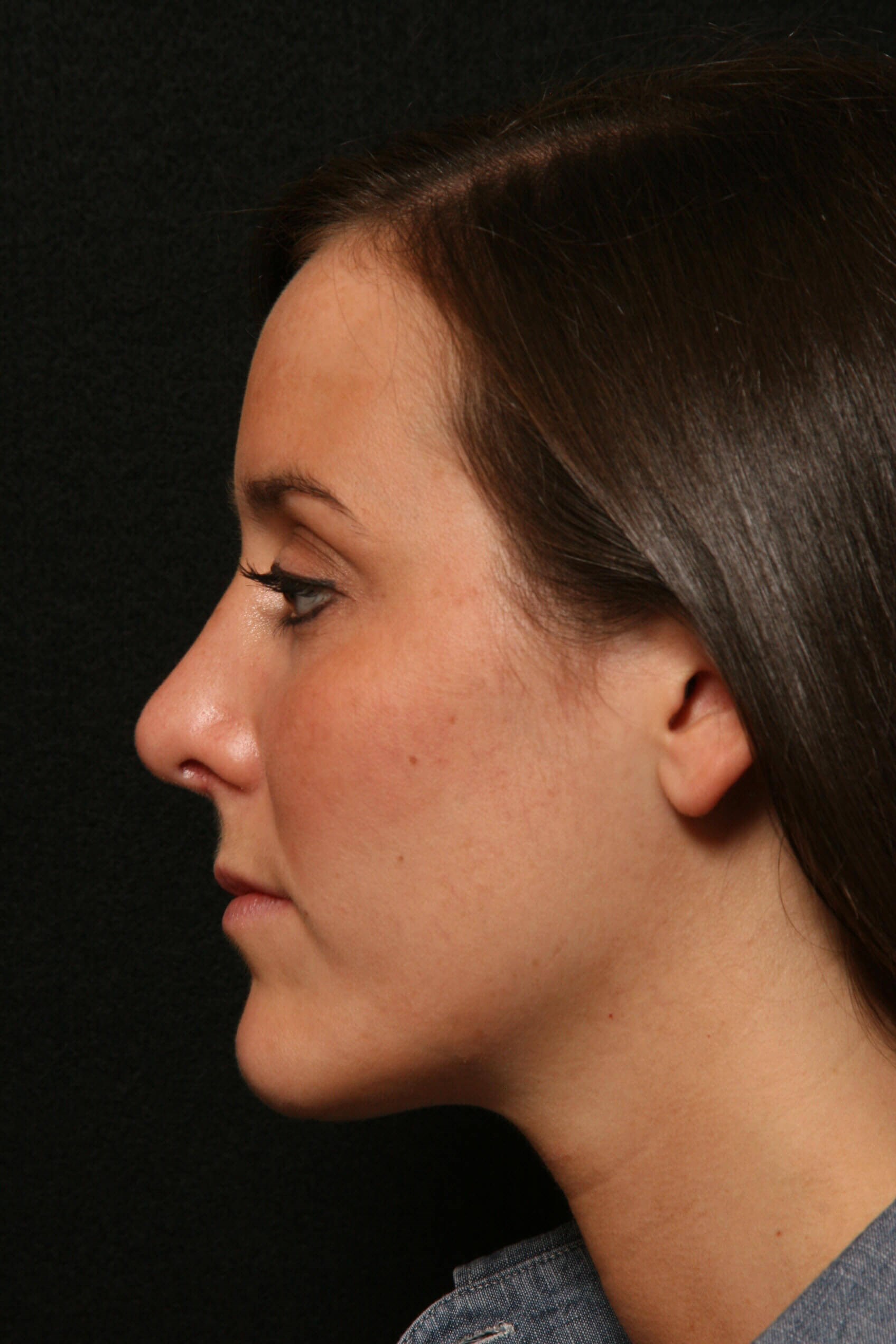 Rhinoplasty Before and After After