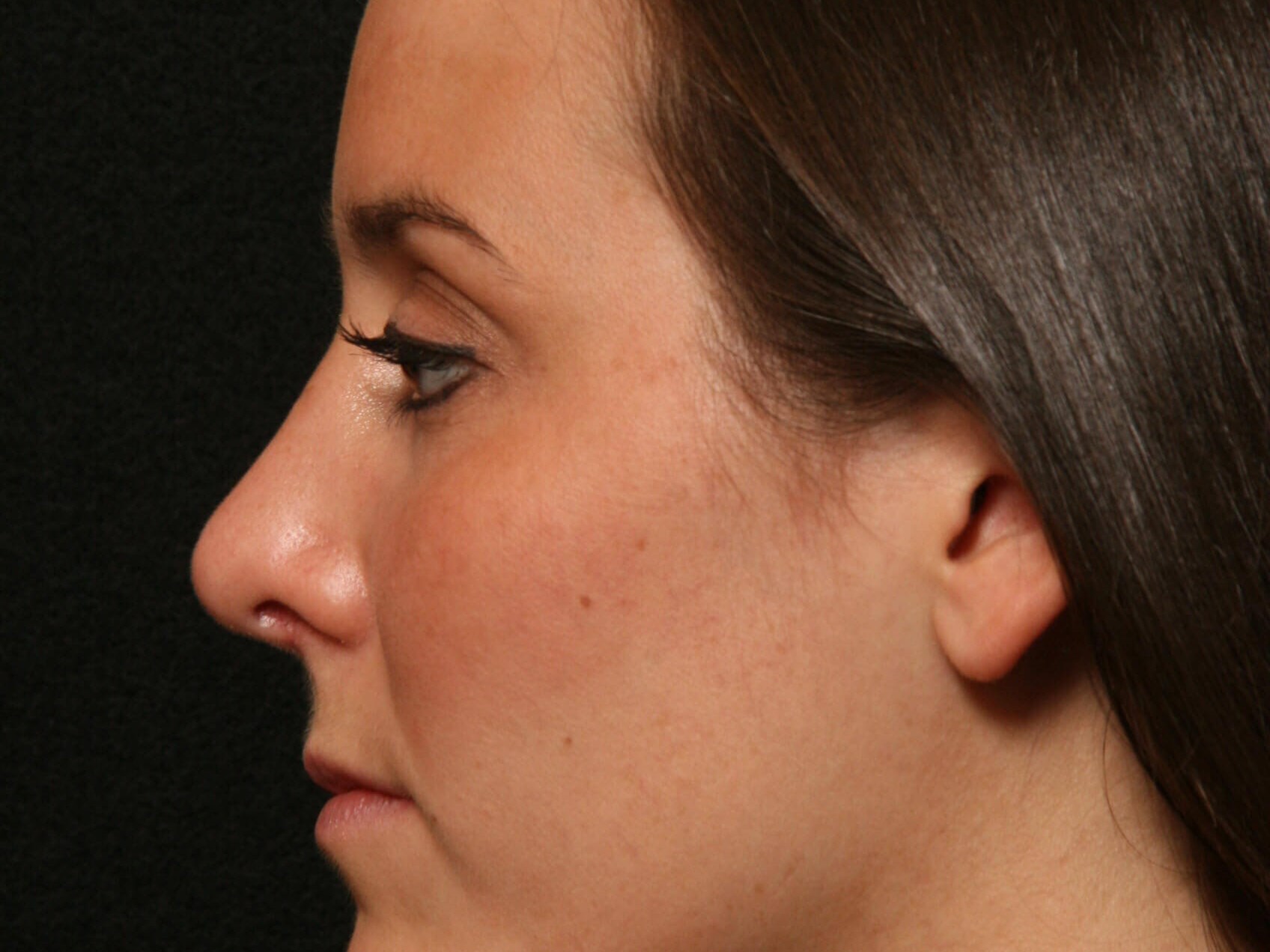 Rhinoplasty Before and After After