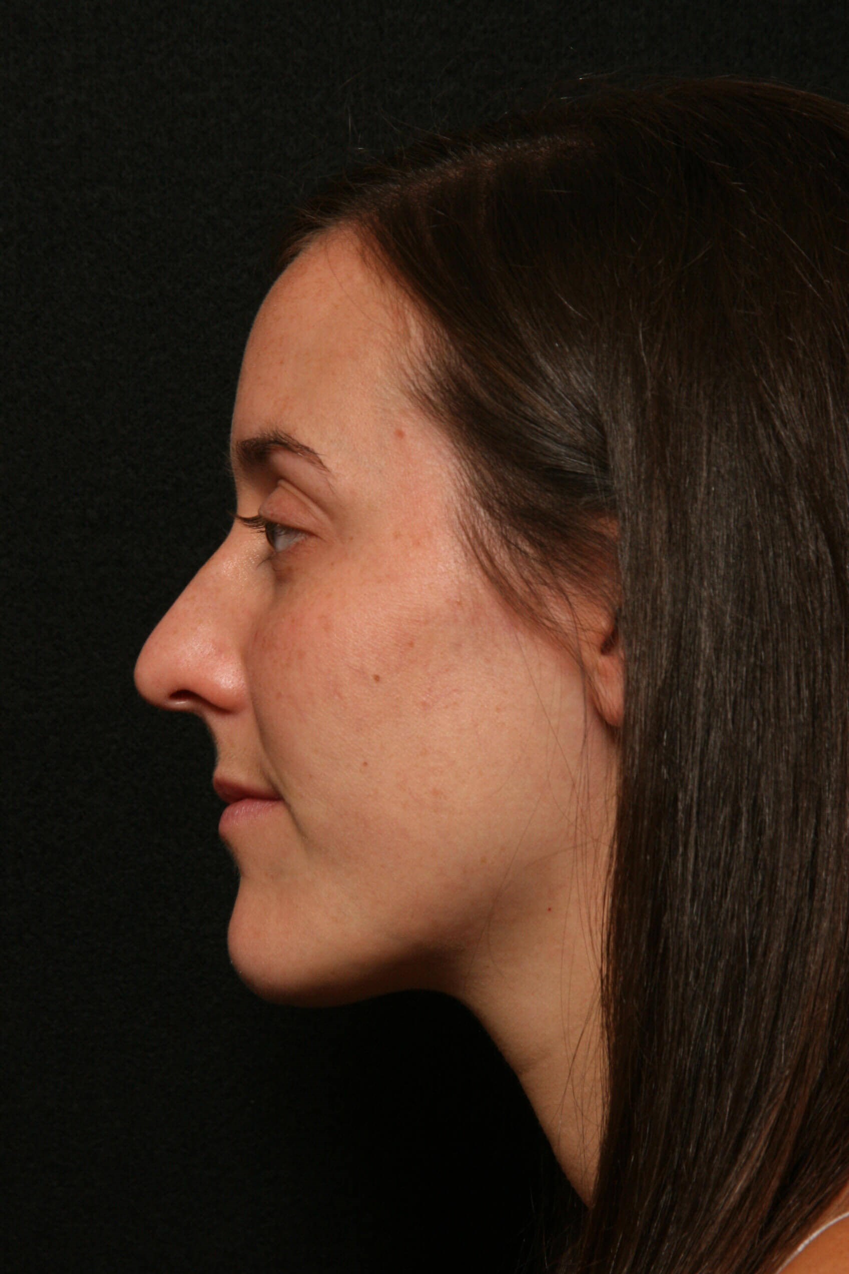 Rhinoplasty Before and After Before