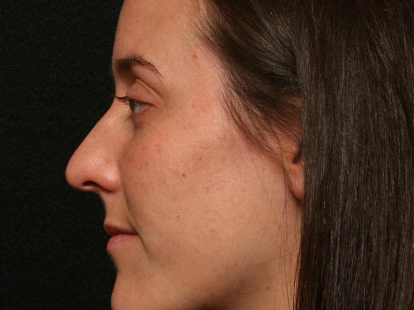 Rhinoplasty Before and After Before