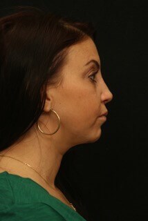 Rhinoplasty Before and After After