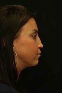 Rhinoplasty Before and After Before