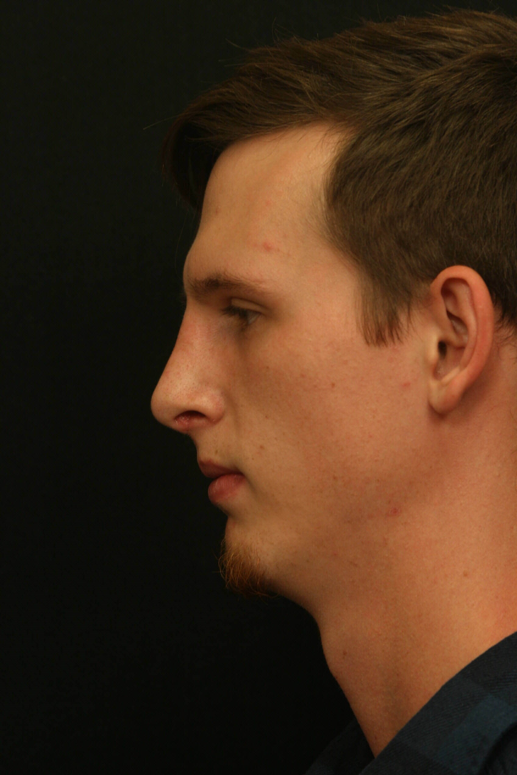 Rhinoplasty Before and After After