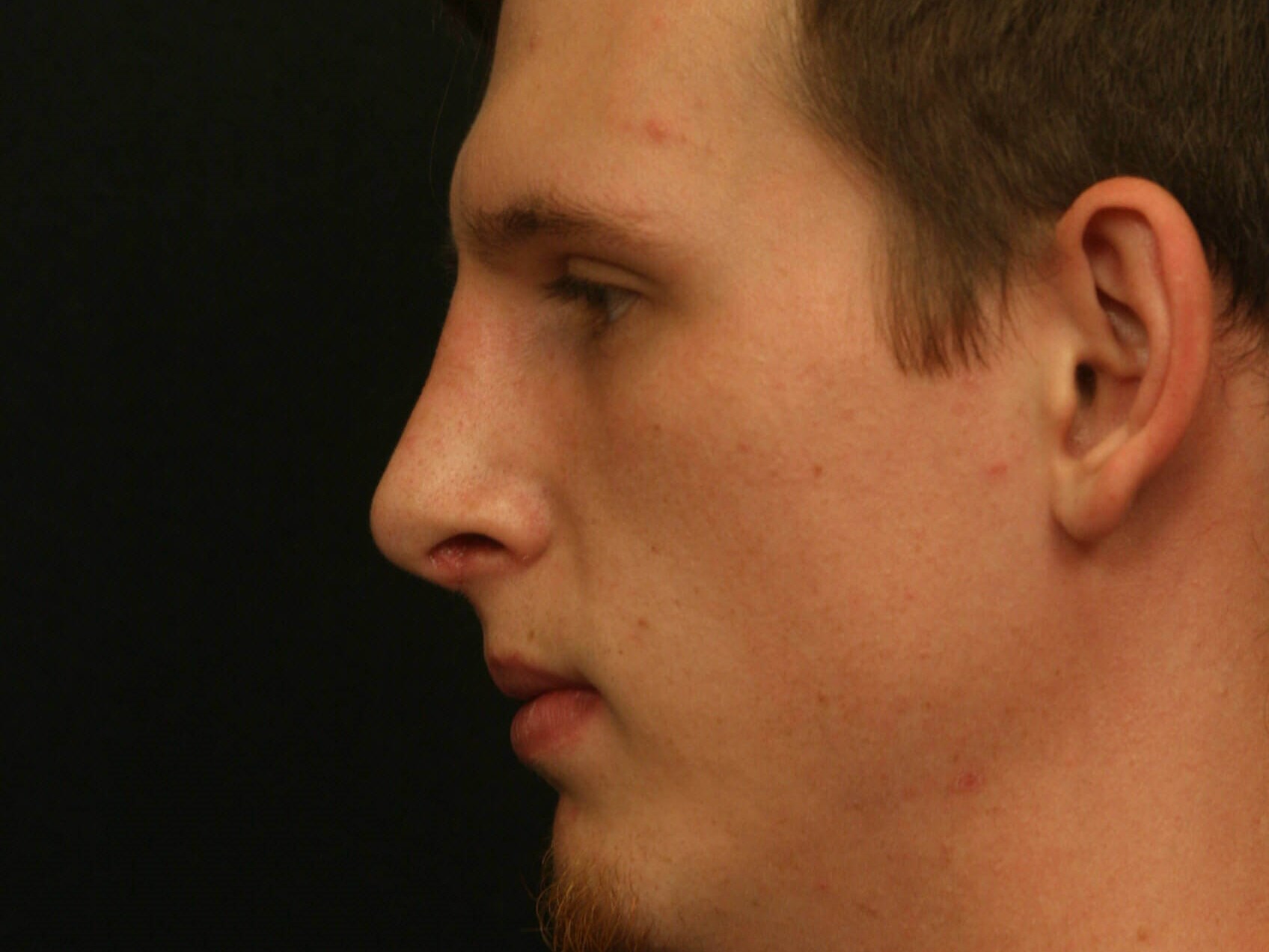 Rhinoplasty Before and After After