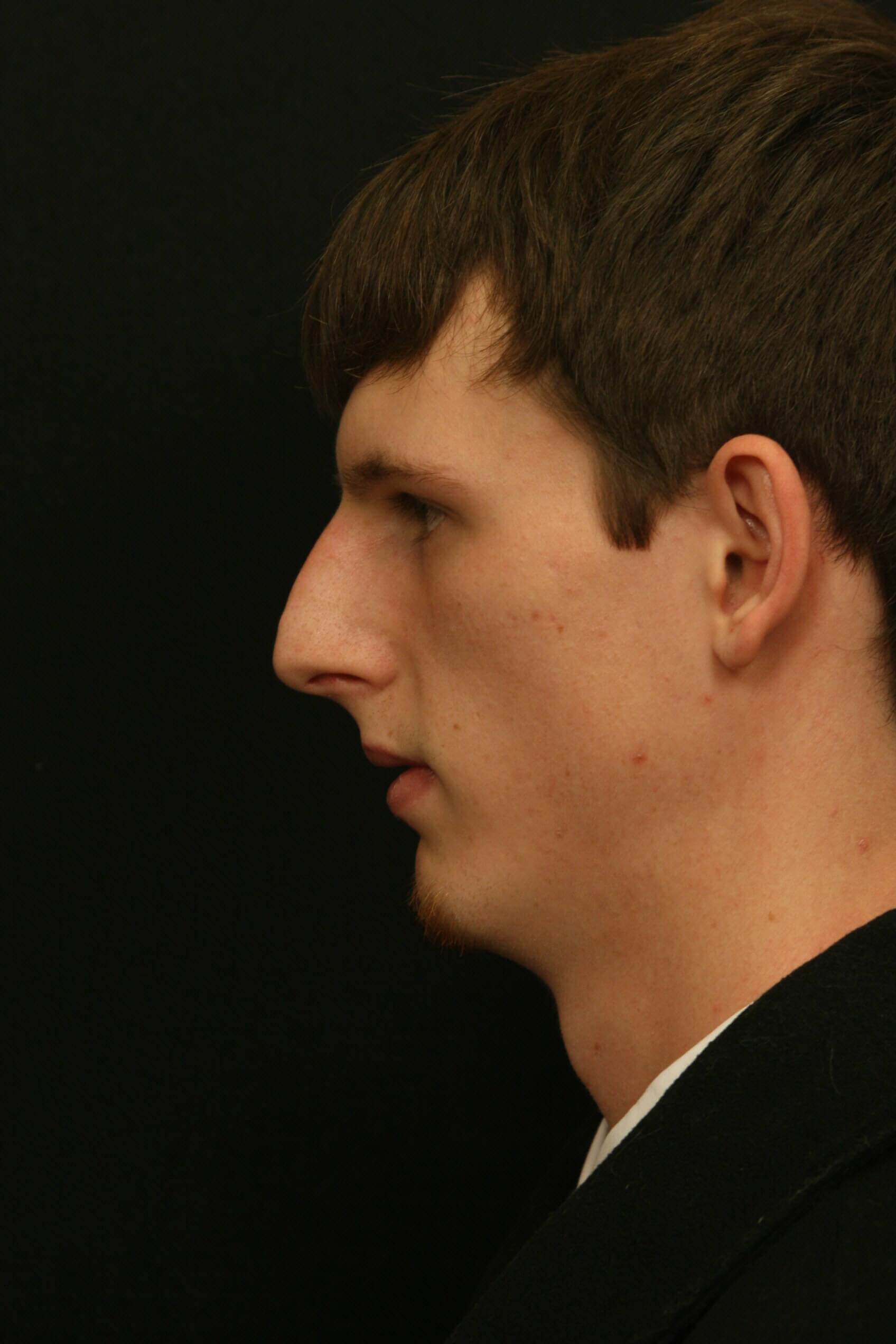 Rhinoplasty Before and After Before