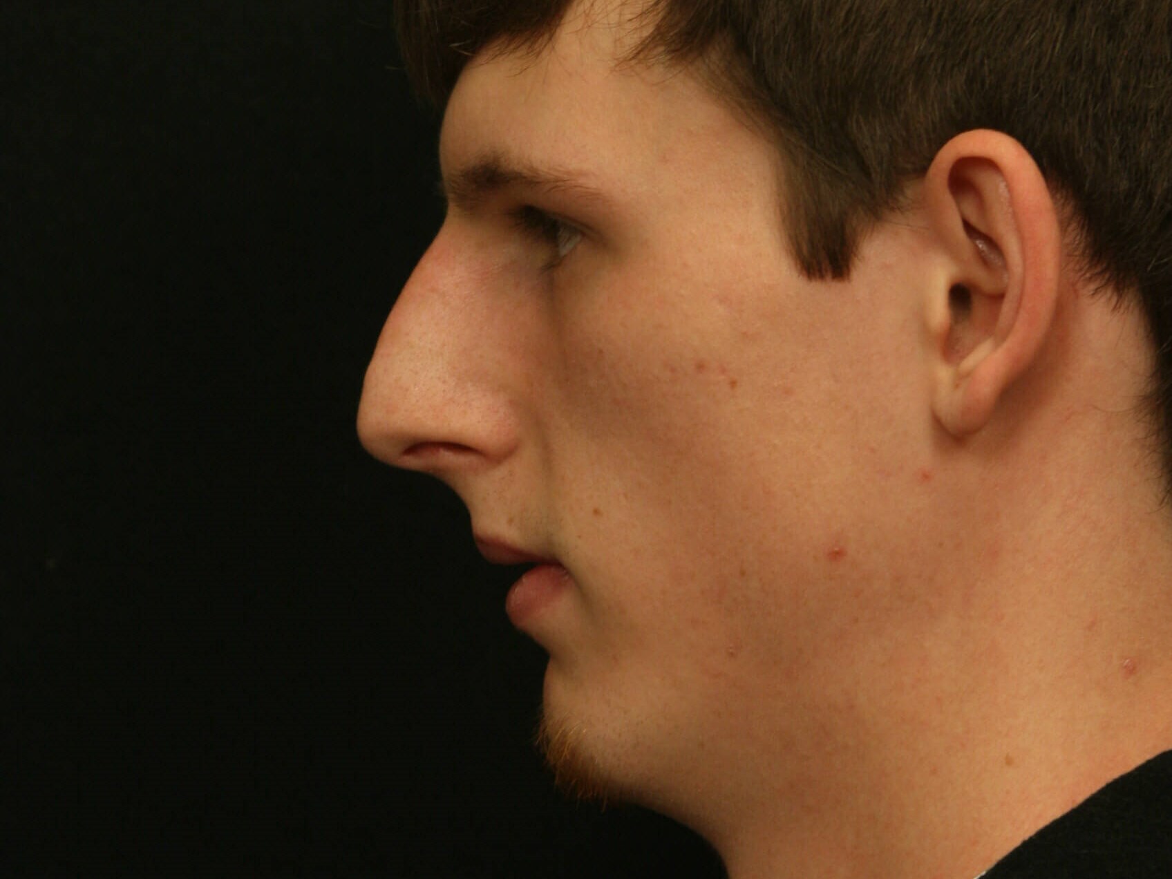 Rhinoplasty Before and After Before