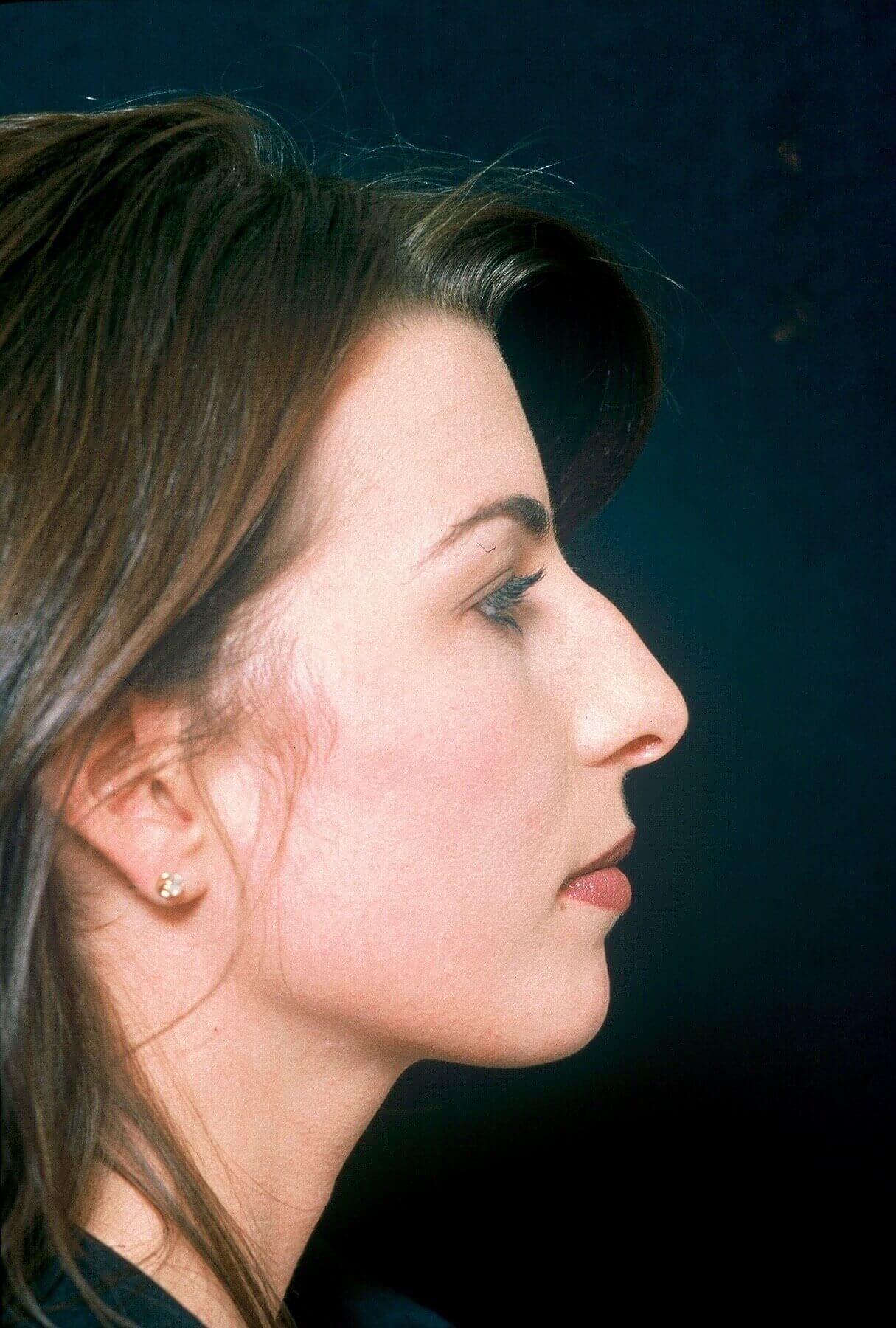 Rhinoplasty Before and After Before