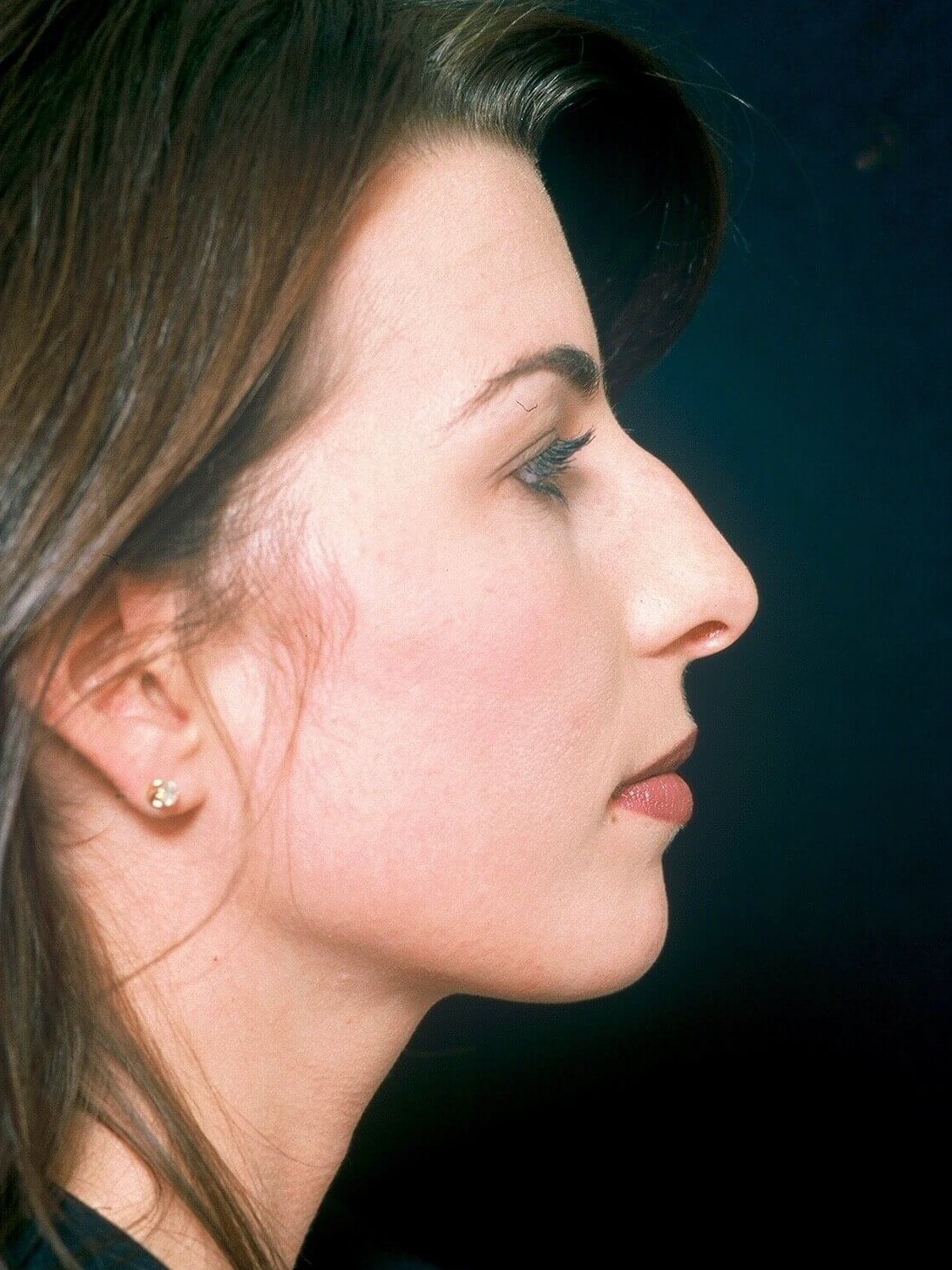 Rhinoplasty Before and After Before