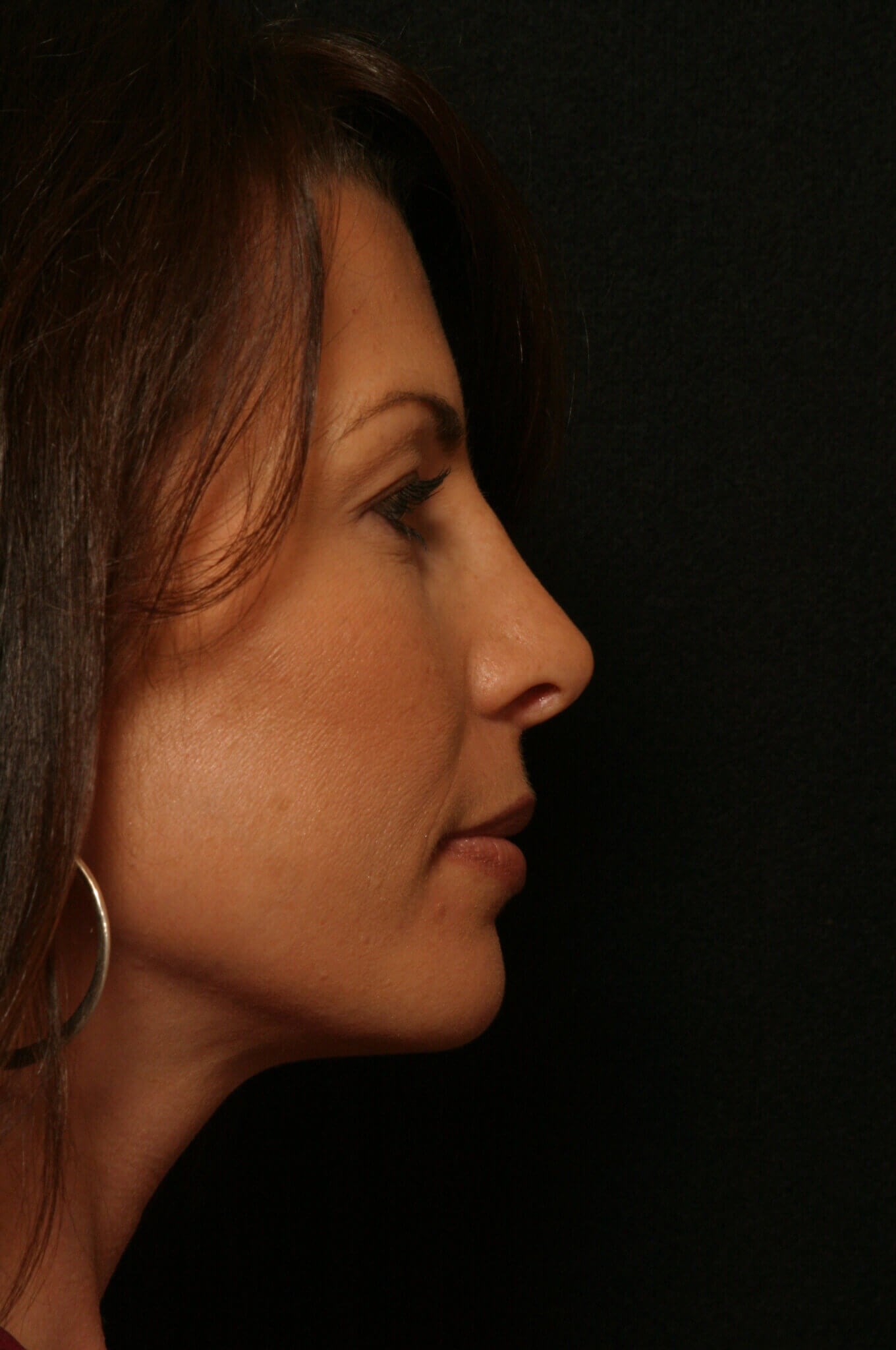 Rhinoplasty Before and After After