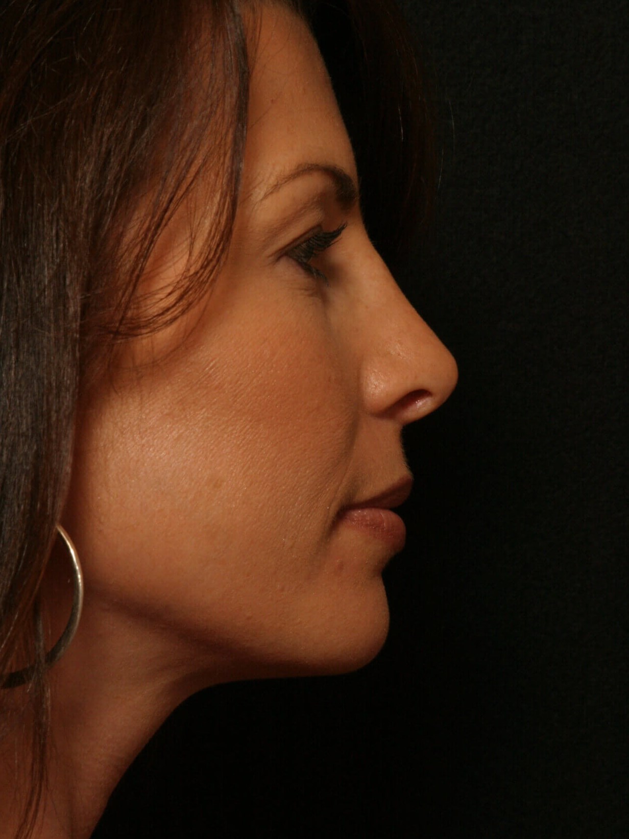 Rhinoplasty Before and After After