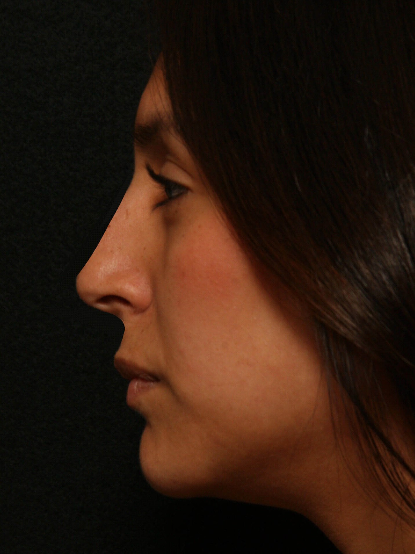 Rhinoplasty Before and After After