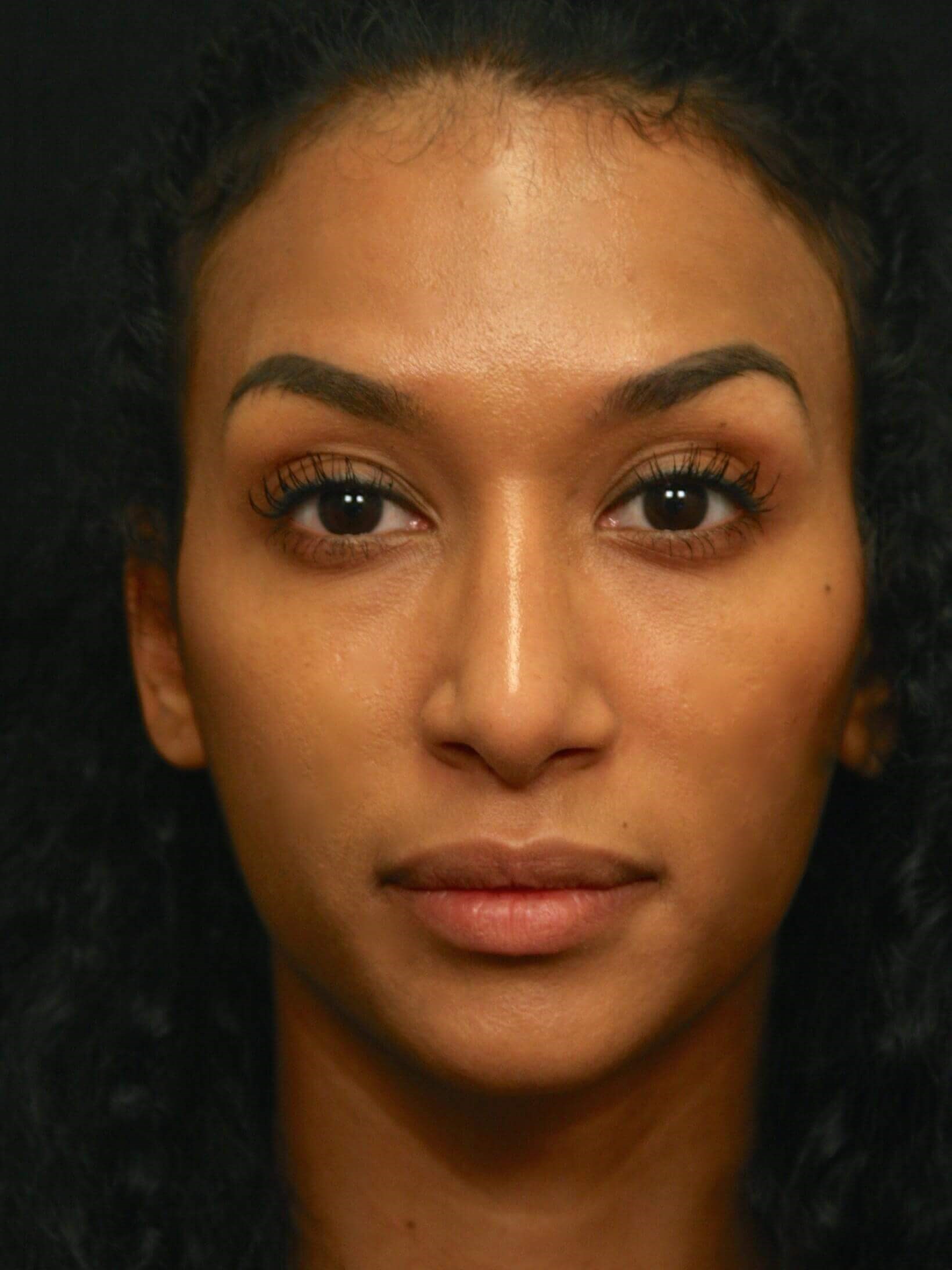 Rhinoplasty Before and After After