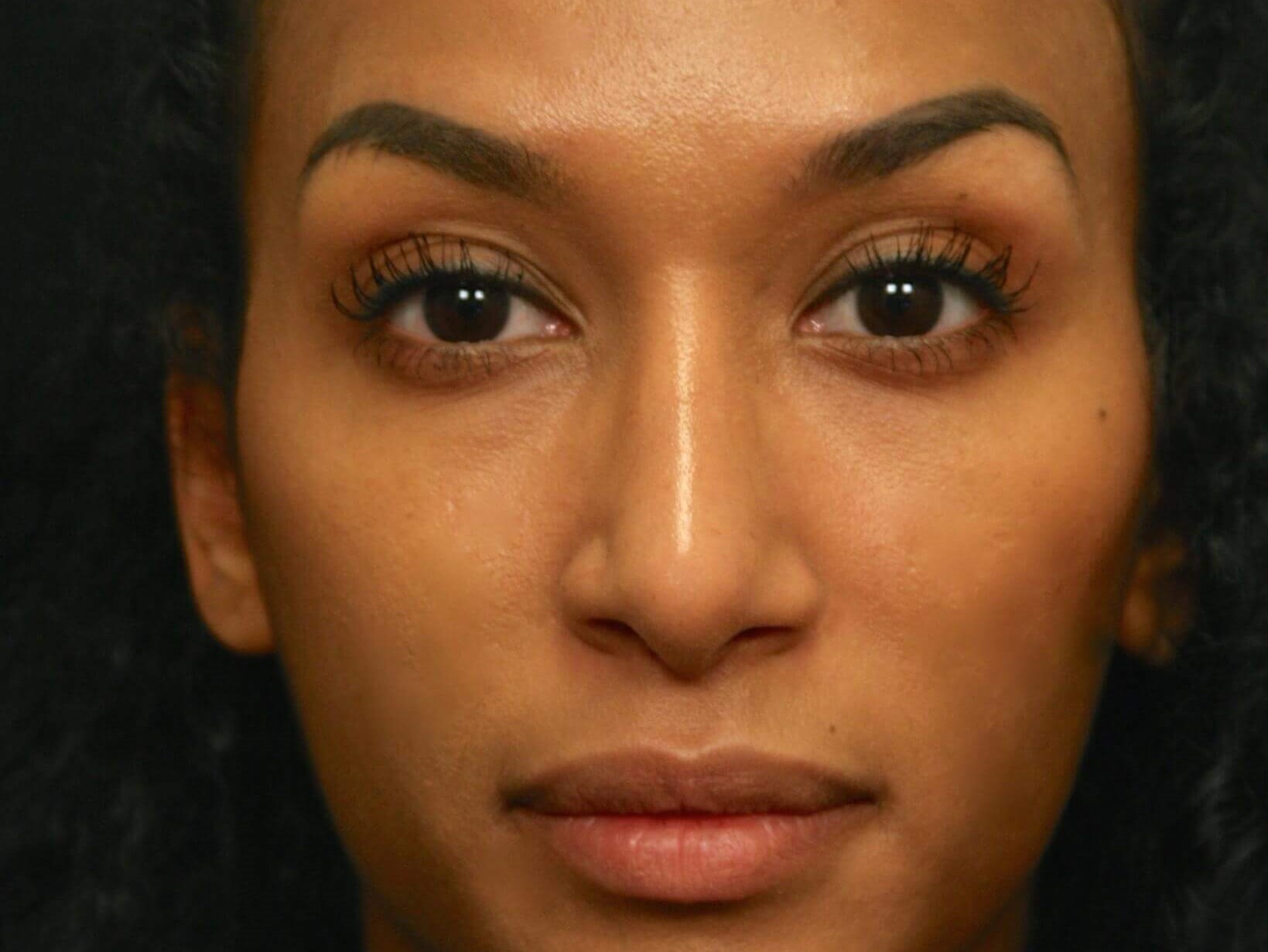 Rhinoplasty Before and After After