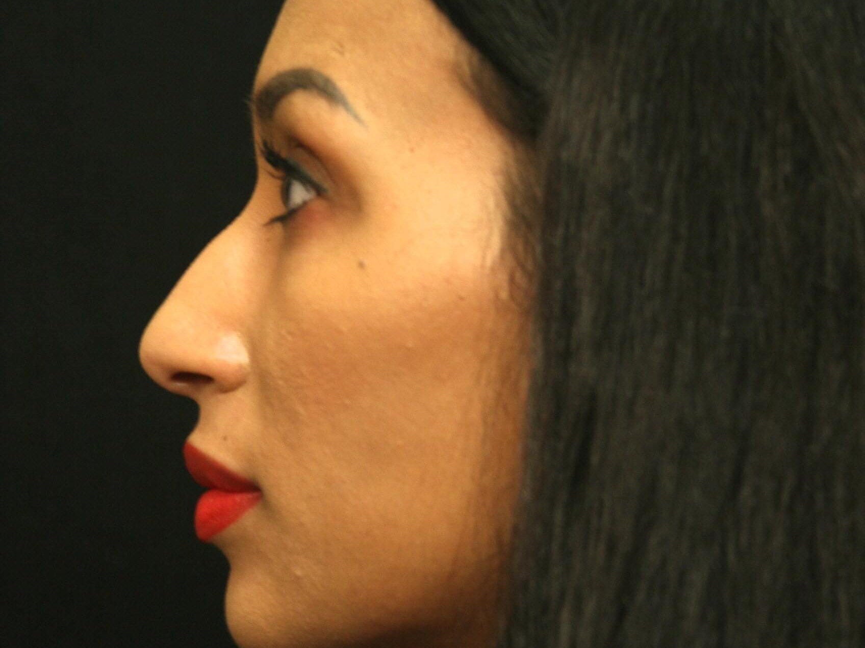 Rhinoplasty Before and After Before