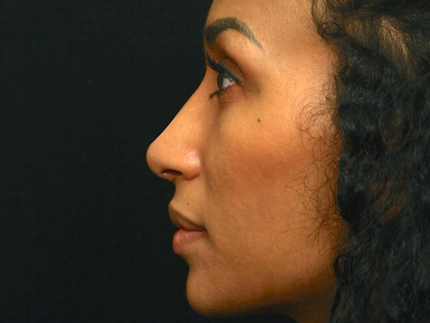 Rhinoplasty Before and After After