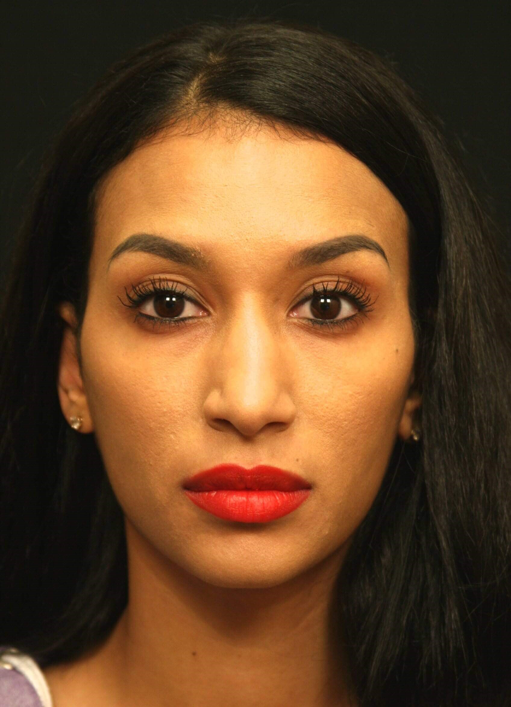 Rhinoplasty Before and After Before