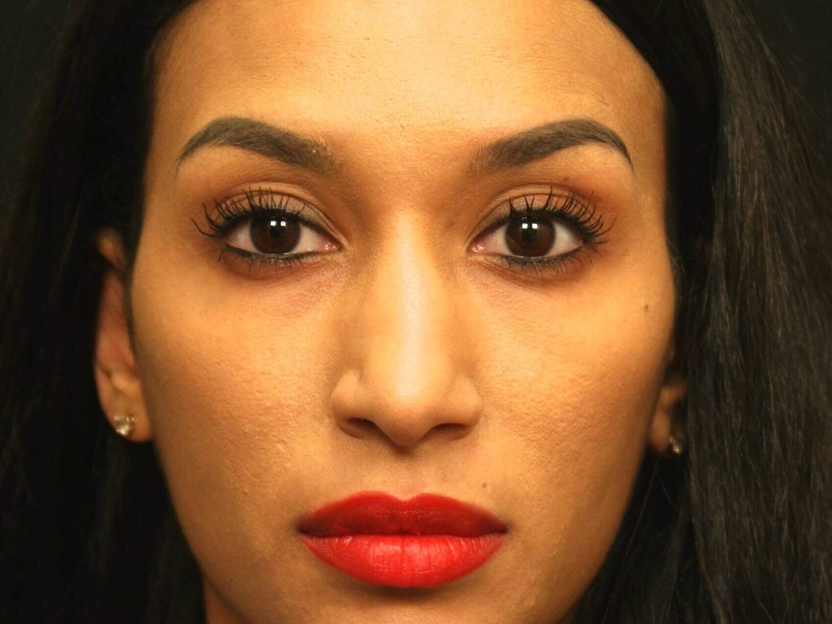 Rhinoplasty Before and After Before