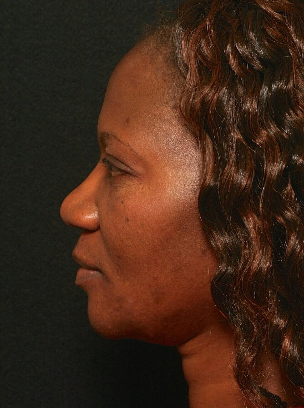 Rhinoplasty Before and After Before