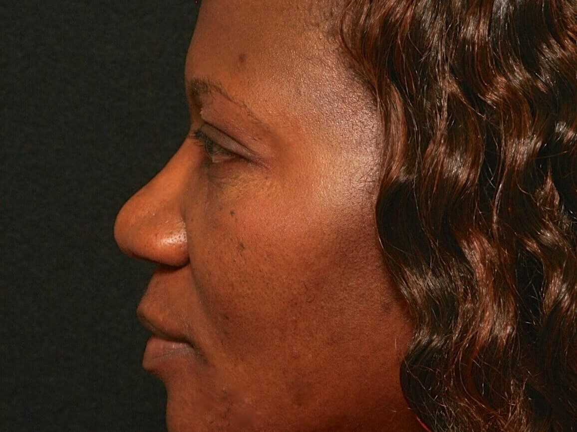 Rhinoplasty Before and After Before