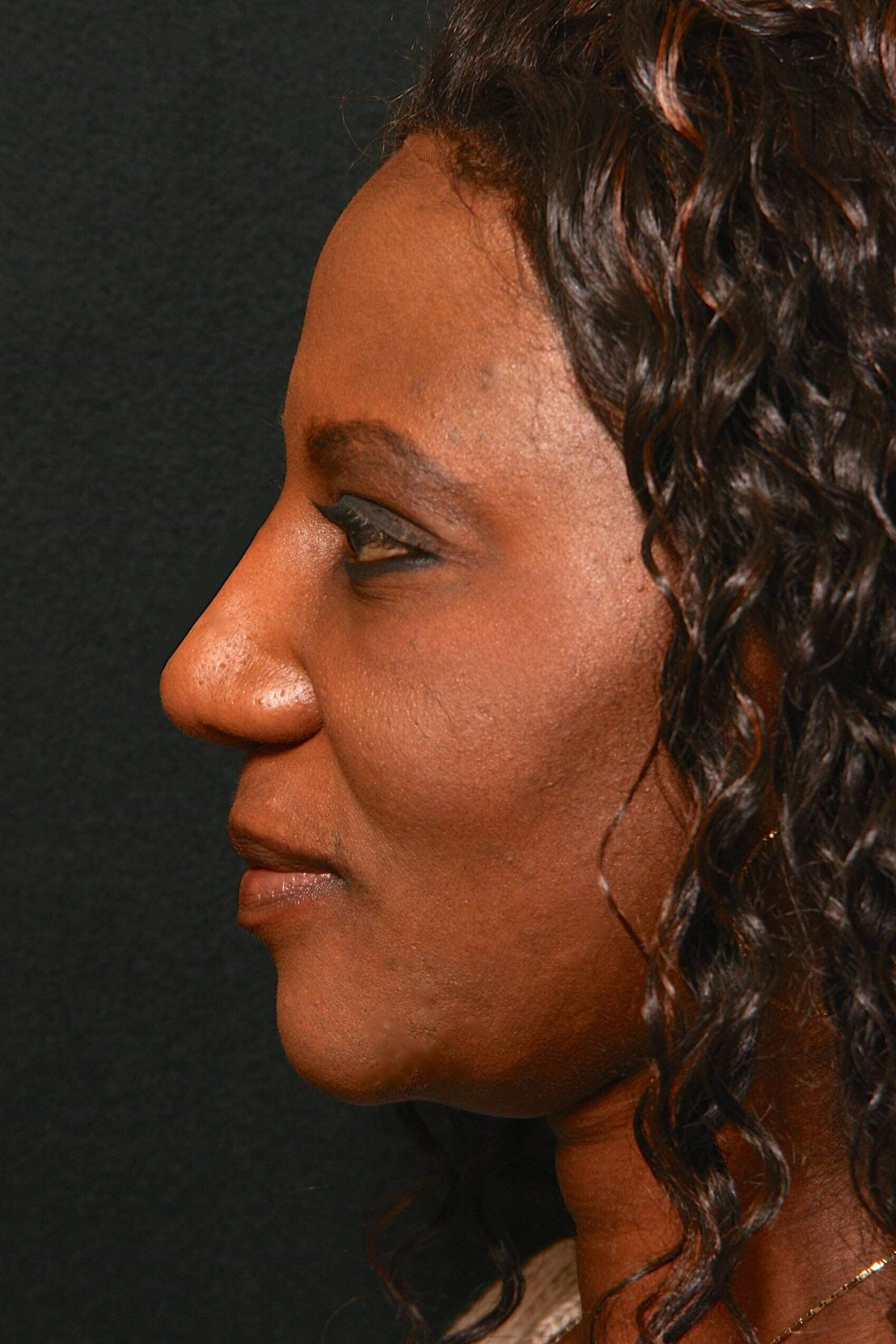 Rhinoplasty Before and After After