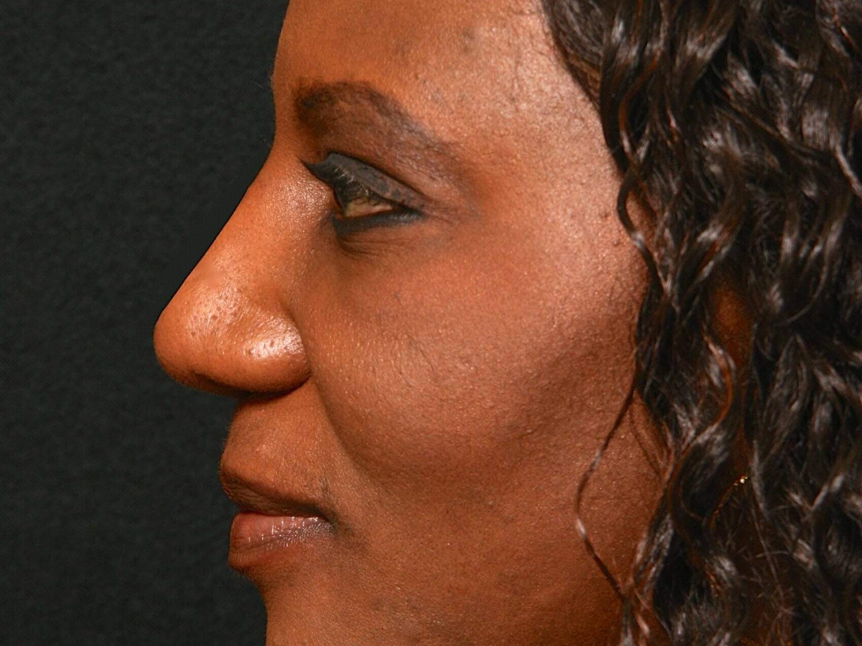 Rhinoplasty Before and After After